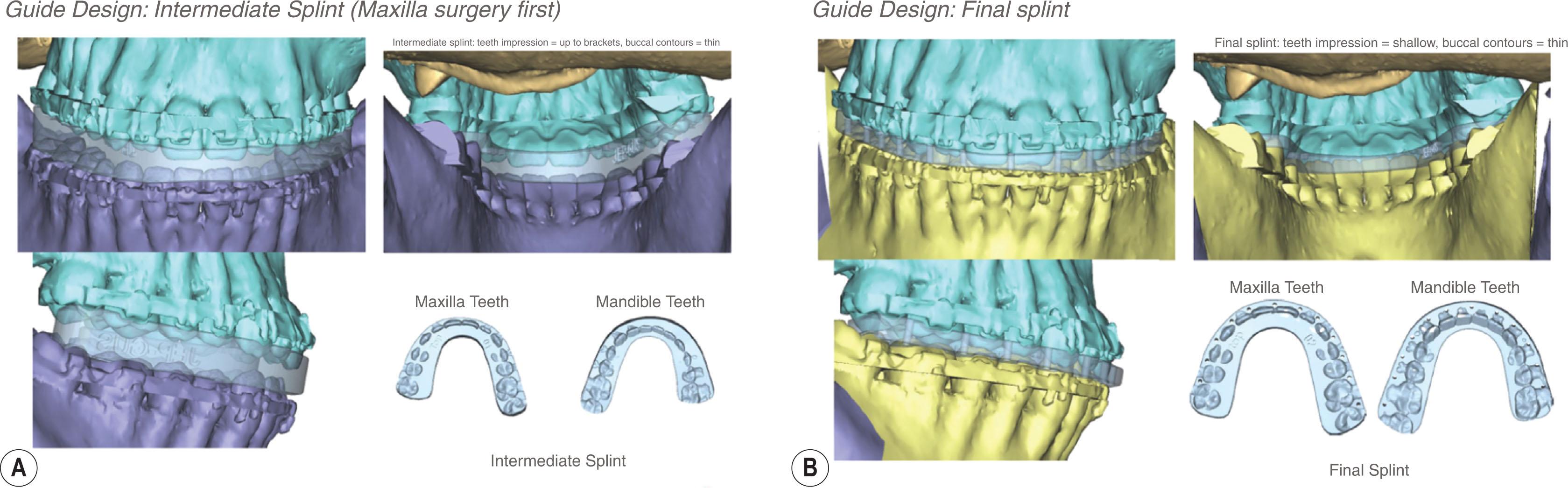 Figure 6.2.7, Virtually designed intermediate and final surgical splints afford the surgeon an opportunity to visualize the splint morphology prior to fabrication. The intermediate (A) and final (B) surgical positions, with the associated splints in situ , can also be simulated.