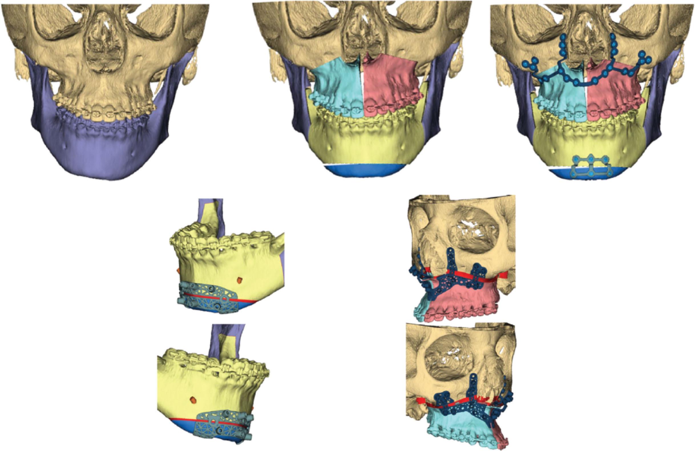 Figure 6.2.8, “Splintless” surgery is possible when using prefabricated cutting guides and custom fixation devices. In this patient with a maxillomandibular discrepancy undergoing maxillary and mandibular surgery, custom cutting guides were utilized for a segmental Le Fort I osteotomy (left) and genioplasty (middle). The cutting guides allow for precise positioning of the skeletal segments using prebent plates (right, bottom), which may obviate the need for occlusal-based splints, even in cases with complex movements (right, top).