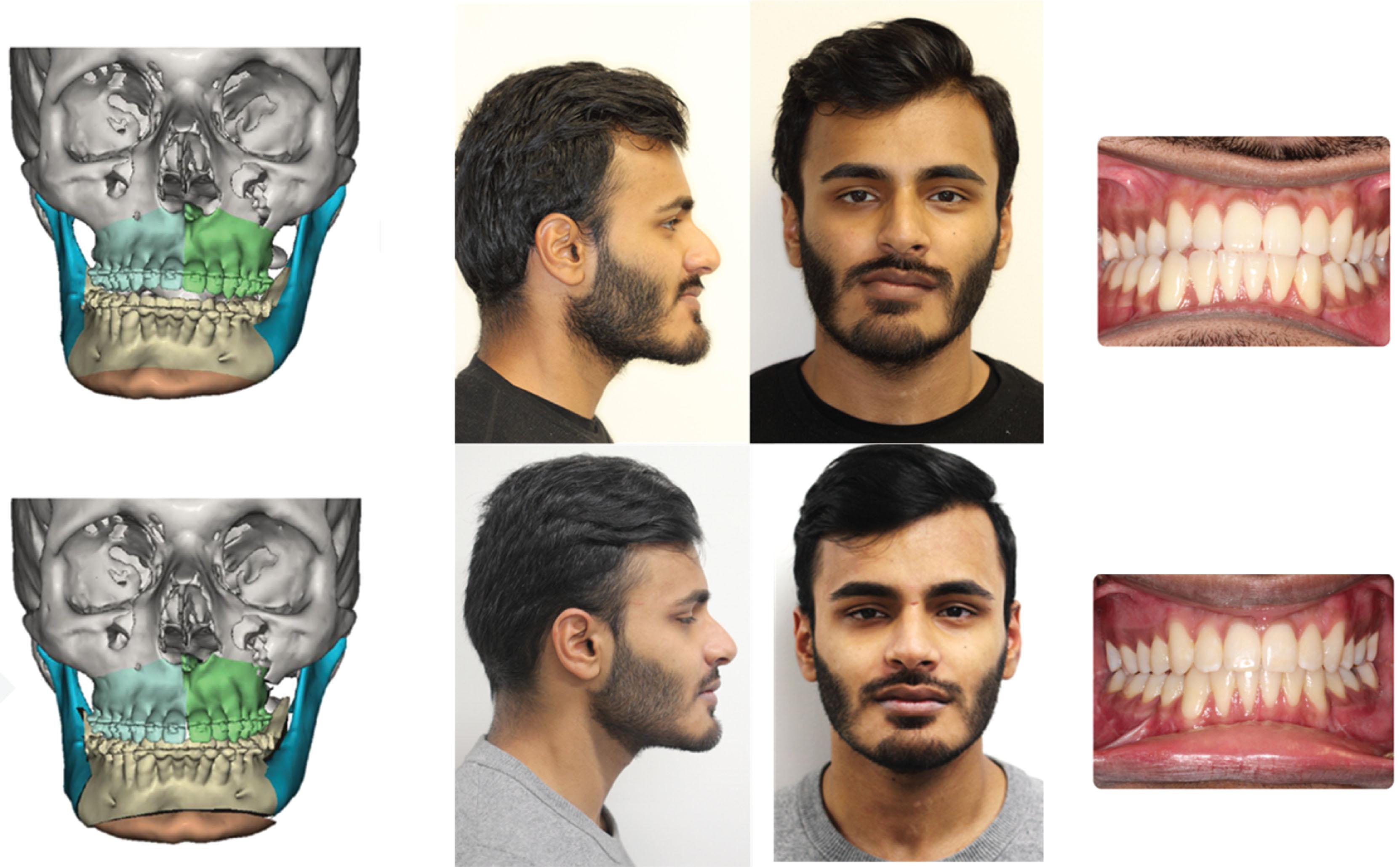 Figure 6.2.9, Virtual surgical planning (left) was used to address the end-stage skeletal discrepancy in this patient with craniofacial microsomia. Preoperatively, there is a significant facial asymmetry and malocclusion involving both the maxilla and mandible (top middle and right). Surgical correction was undertaken via segmental Le Fort I osteotomy, bilateral mandibular sagittal split osteotomies, and genioplasty. The postoperative result at end-treatment shows balanced facial proportions, improved symmetry, and occlusion (bottom middle and right).