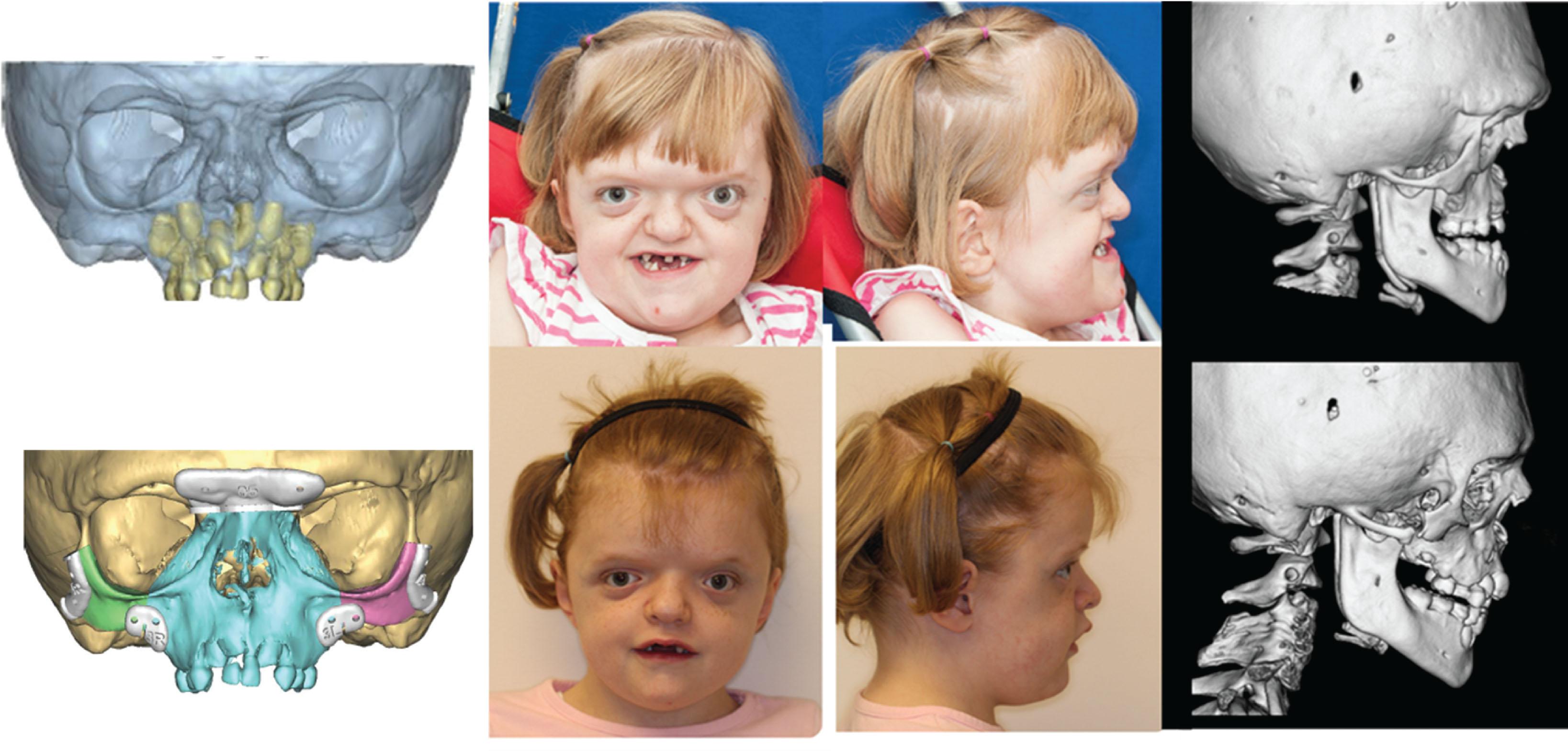 Figure 6.2.10, A segmental Le Fort III osteotomy (Le Fort II with zygomatic repositioning) was indicated in this patient with Apert syndrome to correct the differential midface hypoplasia. Custom cutting guides (bottom, left) can be helpful to avoid injury to the developing succedaneous dentition.