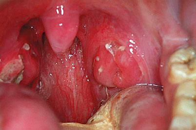 Figure 56, Tonsillitis .