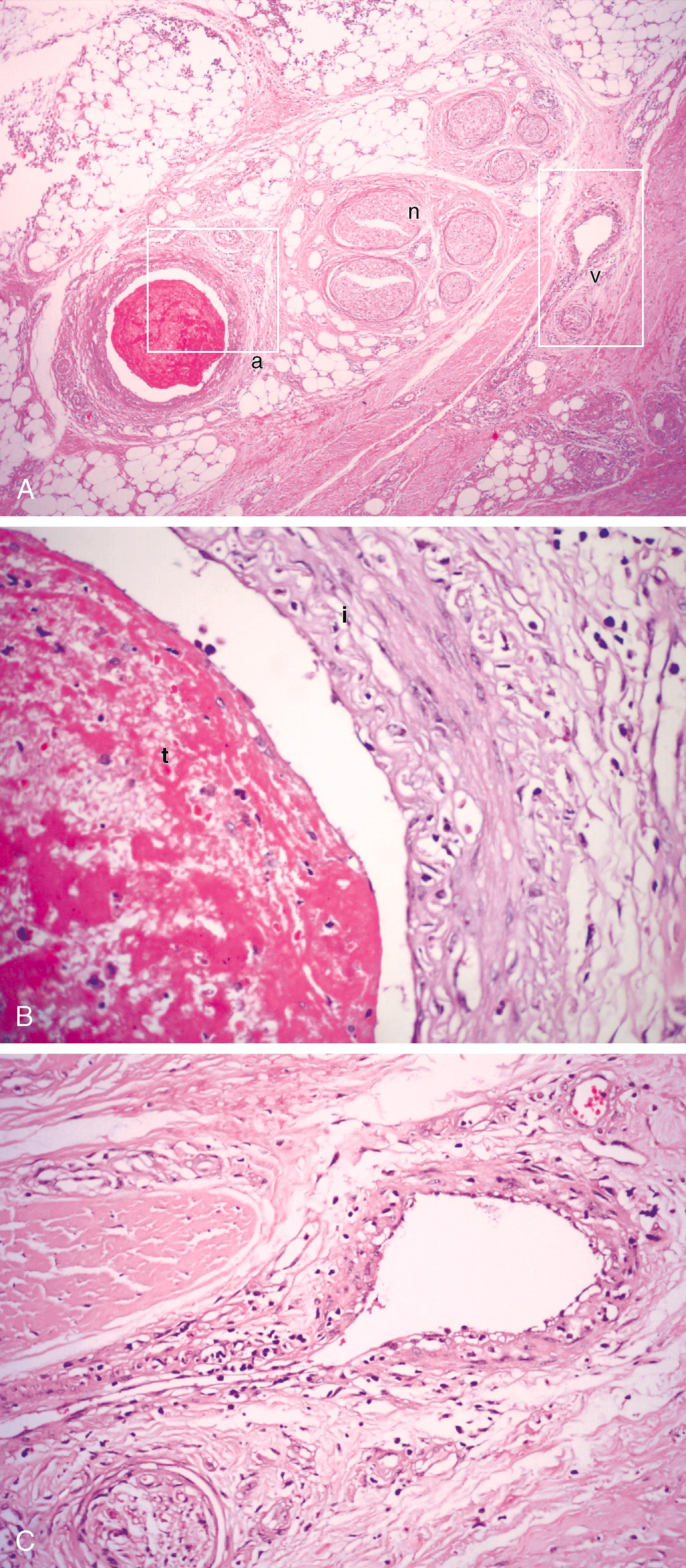 Figure 139.1, ( A ) Typical subacute thrombotic occlusion of the right digital artery in a 37-year-old male smoker with Buerger disease (H&E, ×64). ( B ) High-power view of area a in A demonstrating the digital artery with cellular arterial thrombus (t) and remarkable inflammation in the intima (i) (H&E, ×400). ( C ) High-power view of area v in A demonstrating the adjacent digital vein with phlebitis (H&E, ×400). n , nerve.