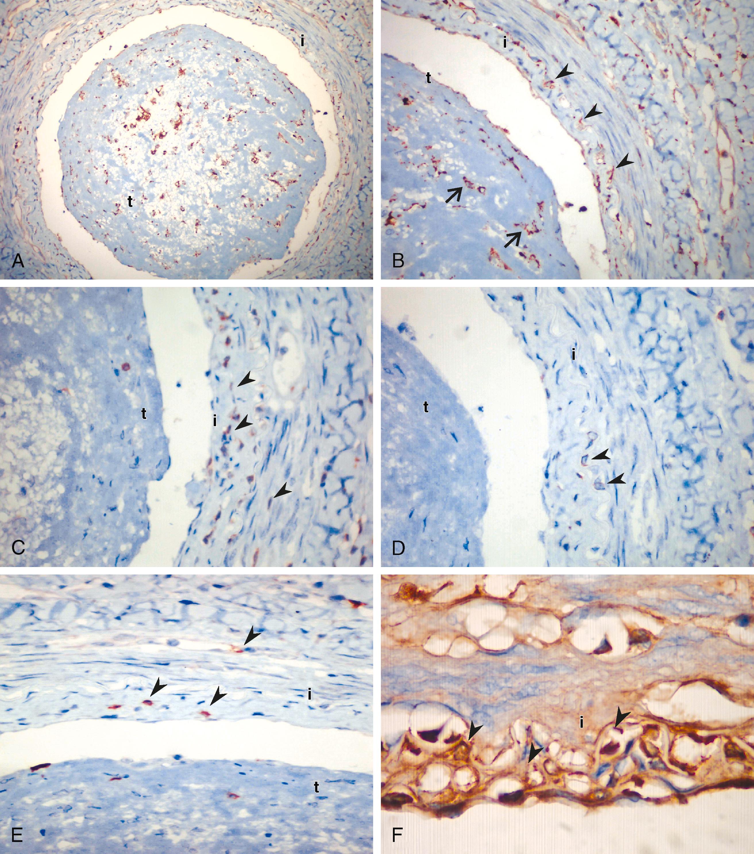 Figure 139.2, ( A ) Microphotograph of an acute-stage lesion with highly cellular thrombus (t) and inflammatory infiltration along the vessel wall with increased anti-CD68 + (clone: KP1) histiocytes. ( B ) High-power view showing highly cellular thrombus (arrows) and abundant histiocytes in the intimal layer (arrowheads) . ( C to E ) Anti-CD3 + (rabbit polyclonal) stained T cells ( C ), anti-CD4 + (clone: 1F6) T-helper cells ( D ), and anti-CD8 + (clone: C8/144B) cytotoxic T cells ( E ) in the intimal layer ( arrowheads; brown membrane staining, ×400). ( F ) Deposition of immunoglobulin G (brown, arrowheads ) within the interstitial intimal tissue (×600). Immunohistochemistry was performed with a Ventana iVIEW DAB detection system. i, intima.