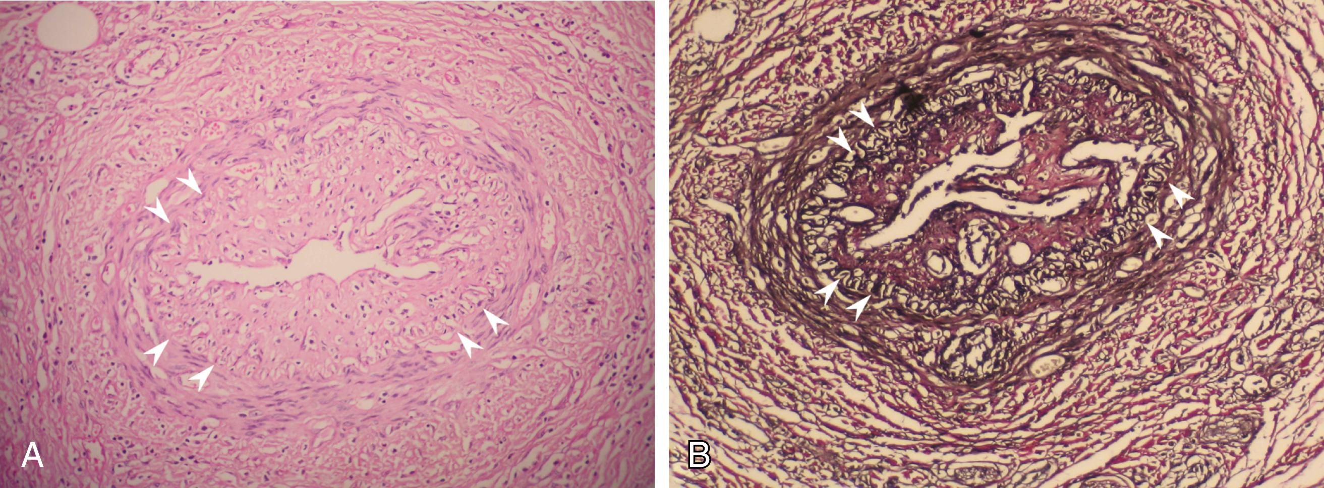 Figure 139.3, ( A ) Microphotograph of a chronic-stage lesion of Buerger disease, with recanalized arterial thrombus and striking intimal thickening (H&E, ×200). The internal elastic lamina (arrowheads) and the architecture of the vascular wall are well preserved. ( B ) The same vessel stained with elastic van Gieson (×200).