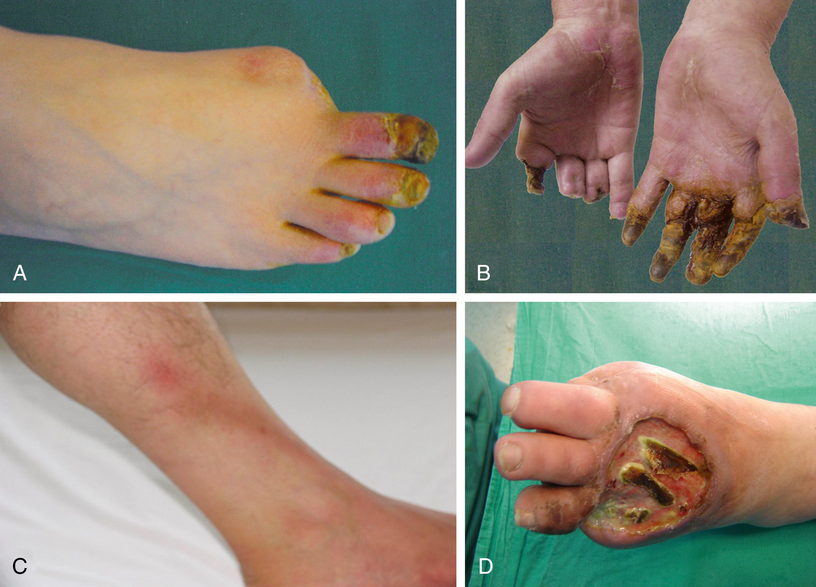 Figure 139.4, ( A ) Ischemic ulceration of the right second toe with a previously amputated great toe in a 42-year-old man who smoked three packs of cigarettes a day for 15 years. ( B ) Necrosis of the ends of almost all fingers led to autoamputation in the same patient after continued smoking. ( C ) One of the cardinal signs of thromboangiitis obliterans is superficial thrombophlebitis, seen here on the left leg of a 28-year-old smoker. Note the hairless skin distally. ( D ) Infected left metatarsal ulceration with osteomyelitis untreated for several weeks in a 32-year-old male patient with previous great and 5th toe amputations.