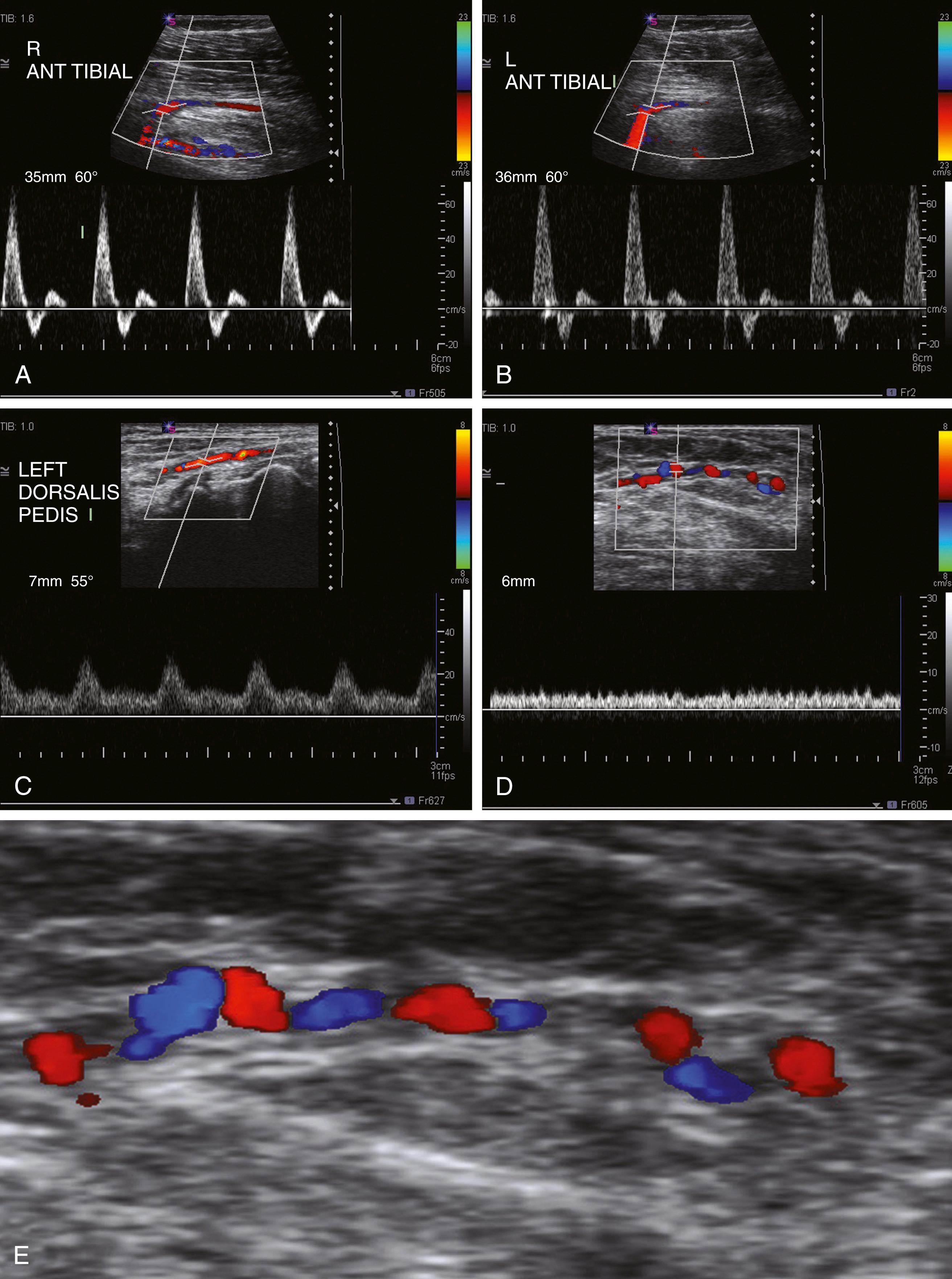 Figure 139.5, Color-flow Doppler studies demonstrating triphasic flow within the right ( A ) and left ( B ) anterior tibial arteries, monophasic flow within the left dorsalis pedis artery ( C ), and the “dot” sign because of continuous flow within corkscrew collaterals at the toe level ( D and E ).