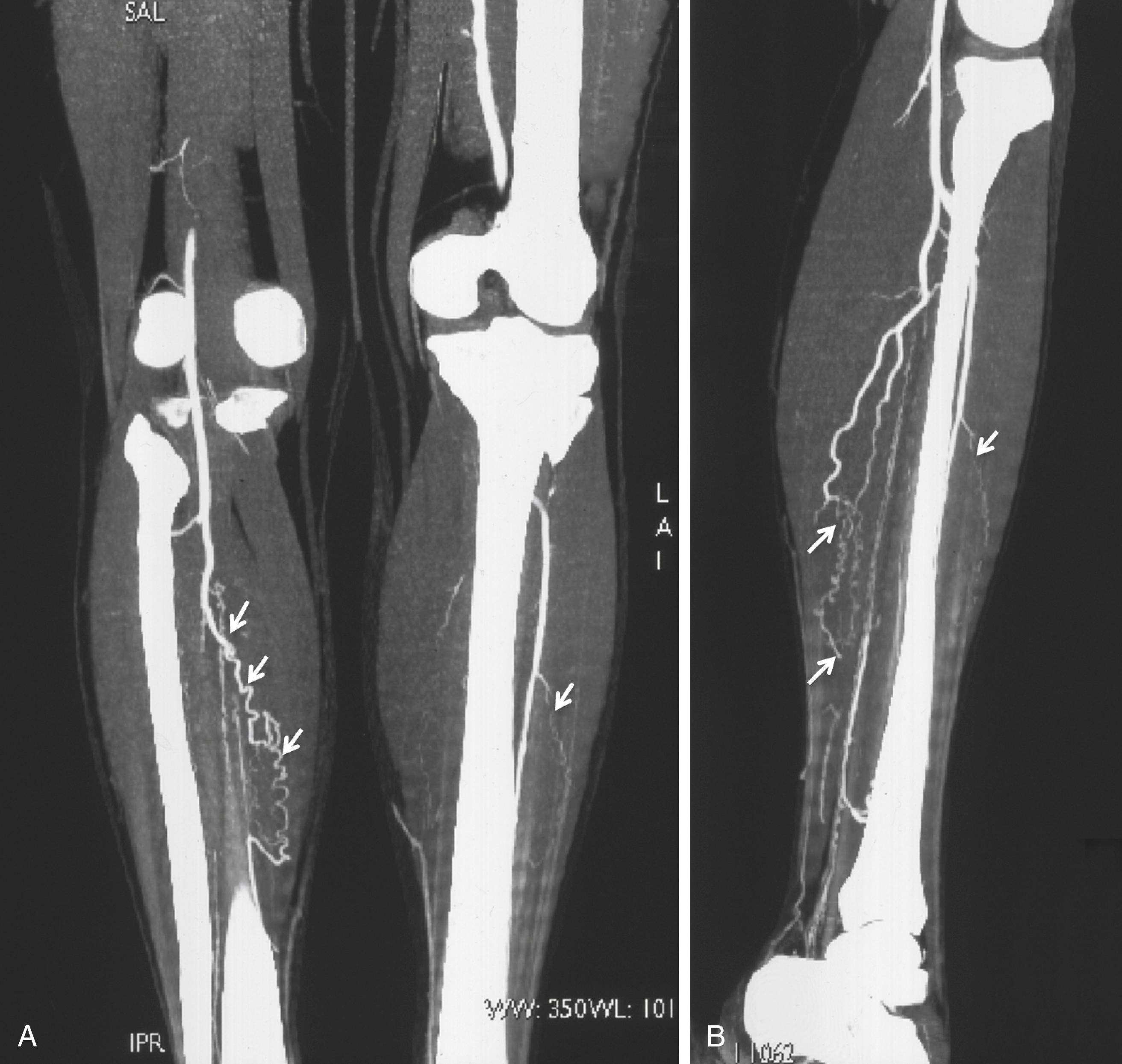 Figure 139.6, ( A and B ) Abrupt right tibial vessel occlusion with corkscrew collaterals (arrows) in a 34-year-old man detected with 64-slice multidetector computed tomographic angiography.