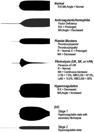 Figure 139.2, An illustration of expected pathological and normal TEG traces. Similar pattern of traces is expected as ROTEM output.