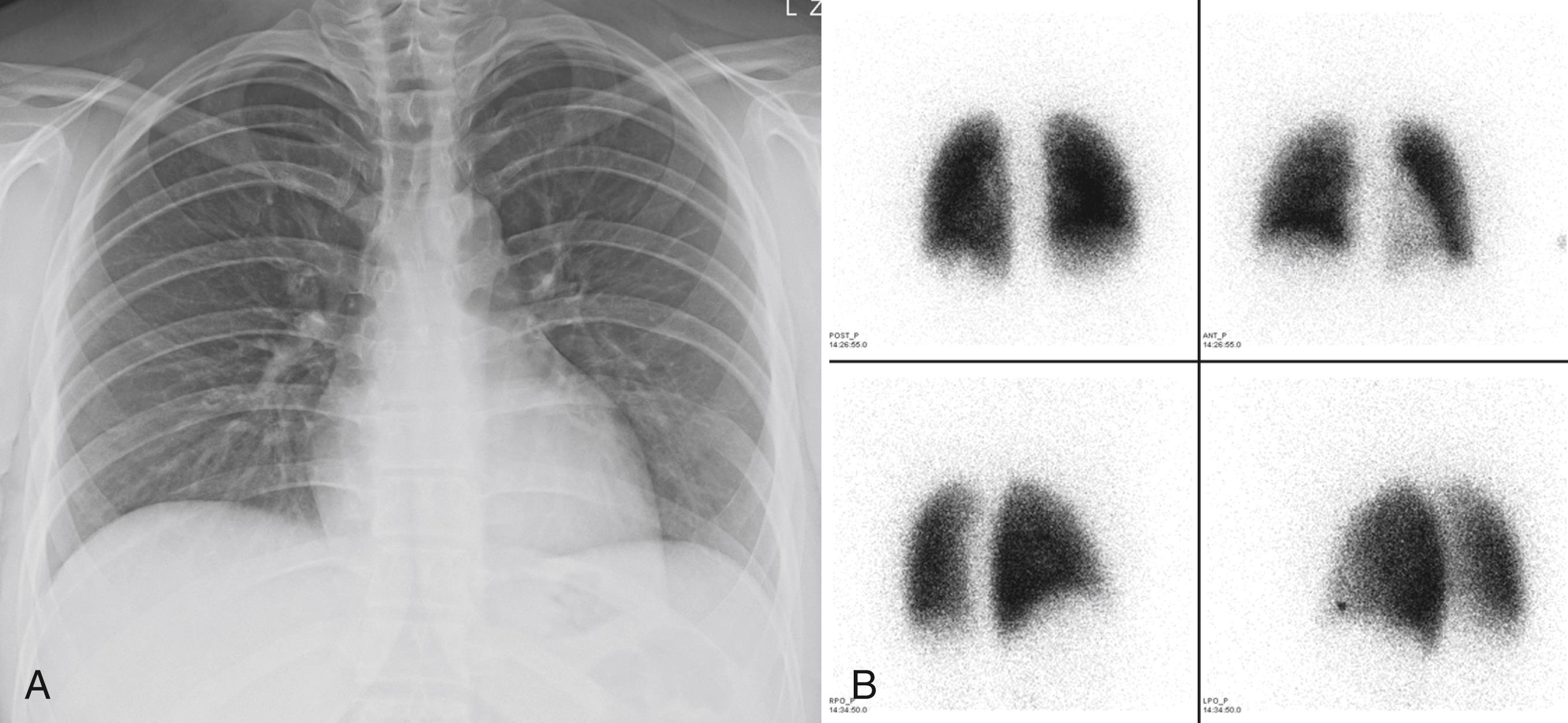 Figure 54.4, Normal chest radiograph and perfusion study in a pregnant woman.