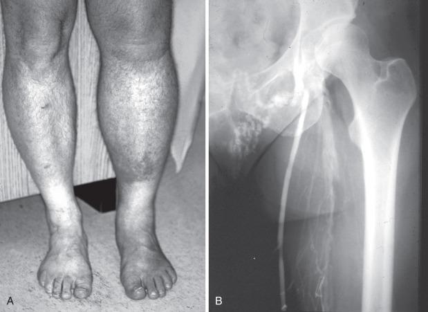 FIG 50.1, (A) Photograph of the lower extremities of a patient suffering iliofemoral deep venous thrombosis 3 months earlier treated with anticoagulation alone. (B) The associated ascending phlebogram demonstrating extensive deep venous obstruction. The saphenous vein is patent, but it too is obstructed at the saphenofemoral junction.