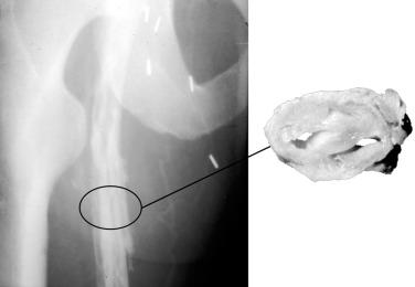 FIG 50.2, Ascending phlebogram of a patient treated for iliofemoral deep venous thrombosis with anticoagulation alone 10 years earlier. A noninvasive vascular laboratory test measuring maximal venous outflow was normal. The ascending phlebogram was read by the radiologist as “tree-barking appearance of chronic venous disease with no evidence of obstruction.” The specimen demonstrates a cross-section of the femoral vein just below the profunda femoris vein after the patient had a classic Linton procedure. One can see extensive luminal obstruction with typical recanalization channels.