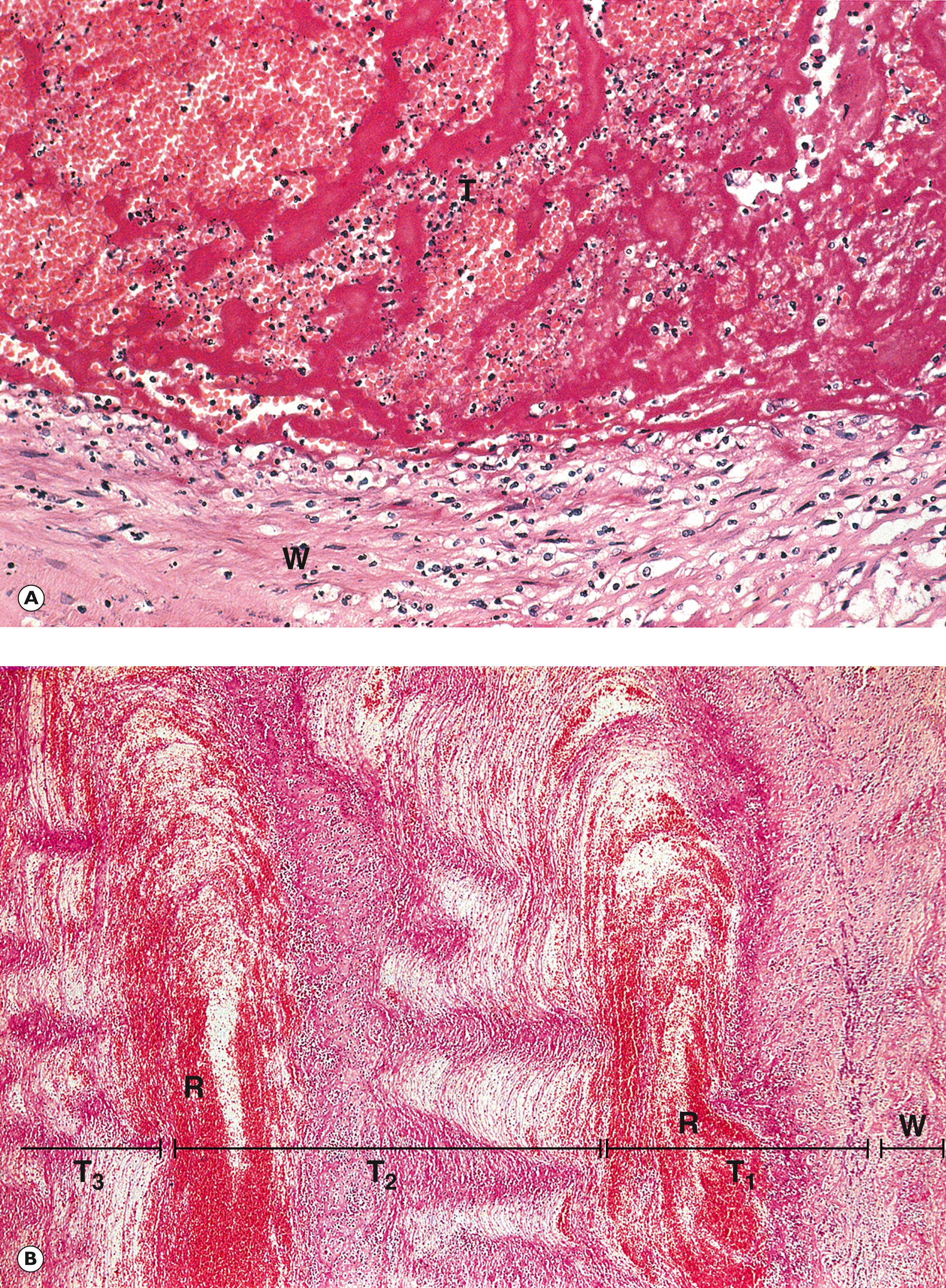 Fig. 9.2, Thrombus formation. (A) Early thrombus (HP); (B) enlargement of thrombus (MP); (C) thrombosis in a vein (LP).