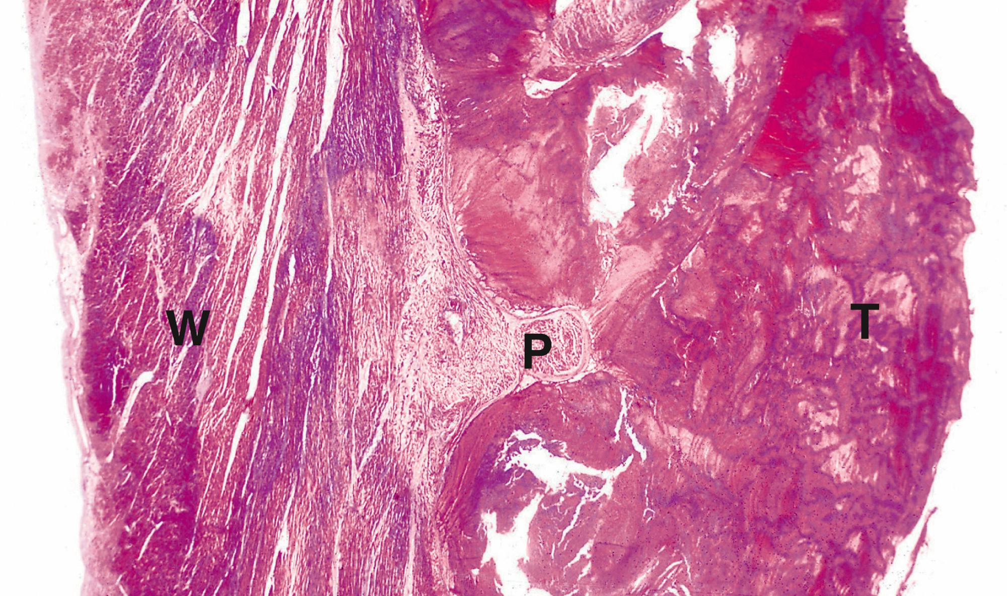 Fig. 9.3, Left ventricular mural thrombus (LP).