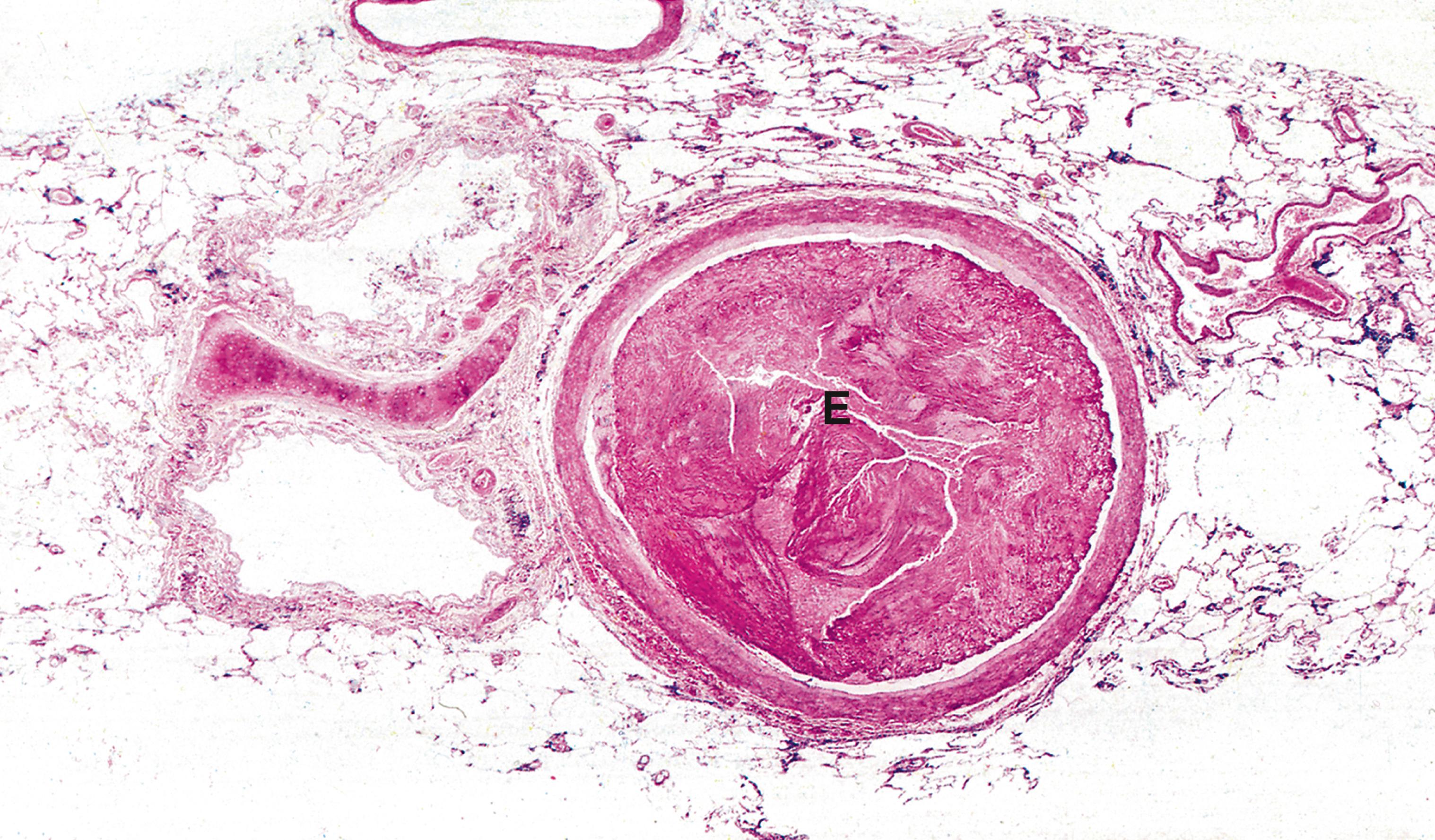 Fig. 9.4, Thromboembolism: pulmonary embolus (LP).