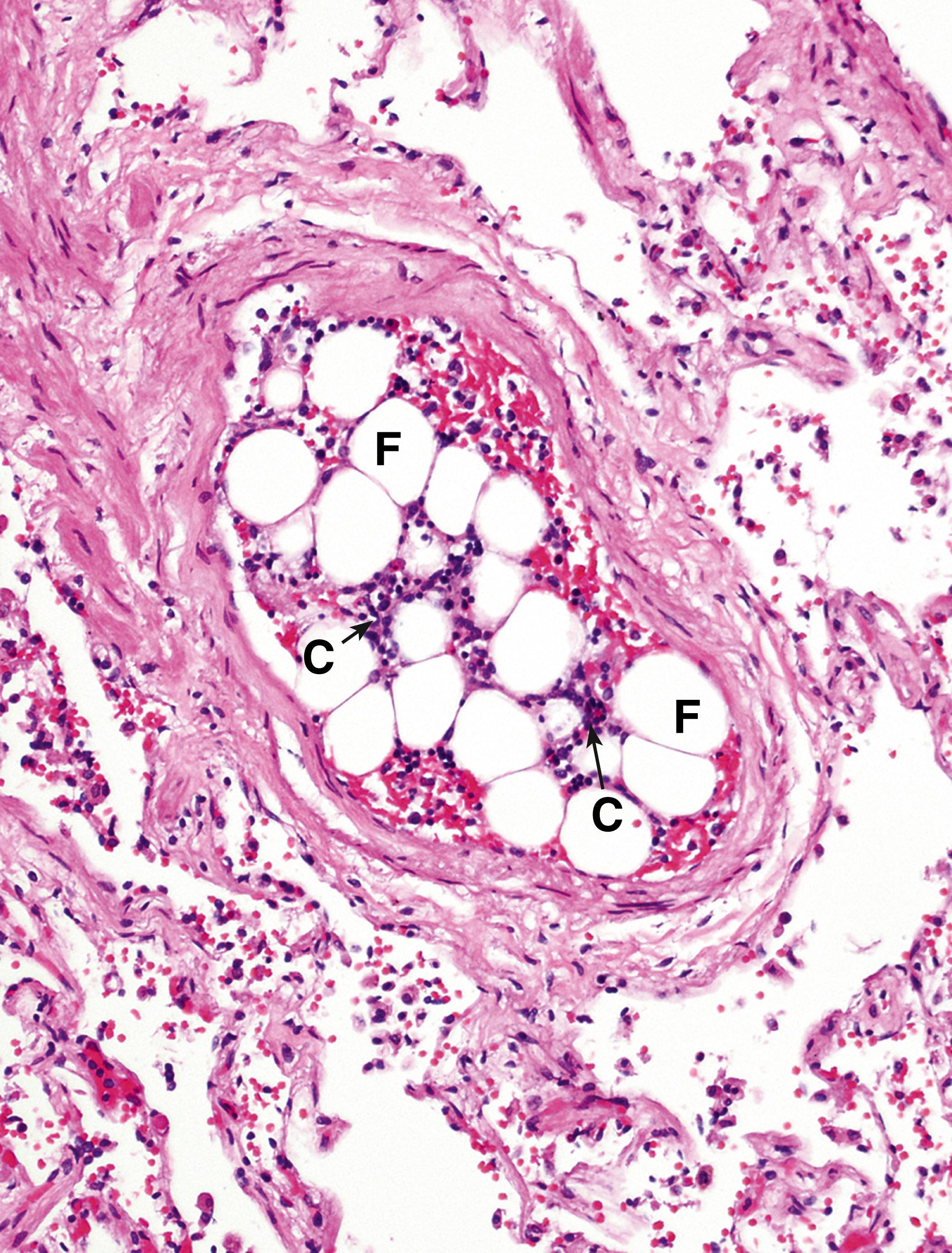 Fig. 9.5, Bone marrow embolus (MP).