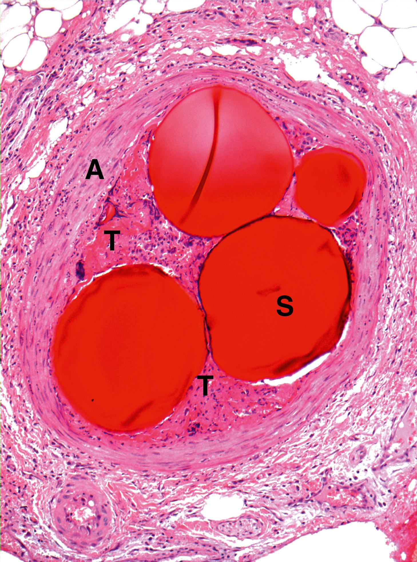 Fig. 9.6, Therapeutic embolisation (MP).