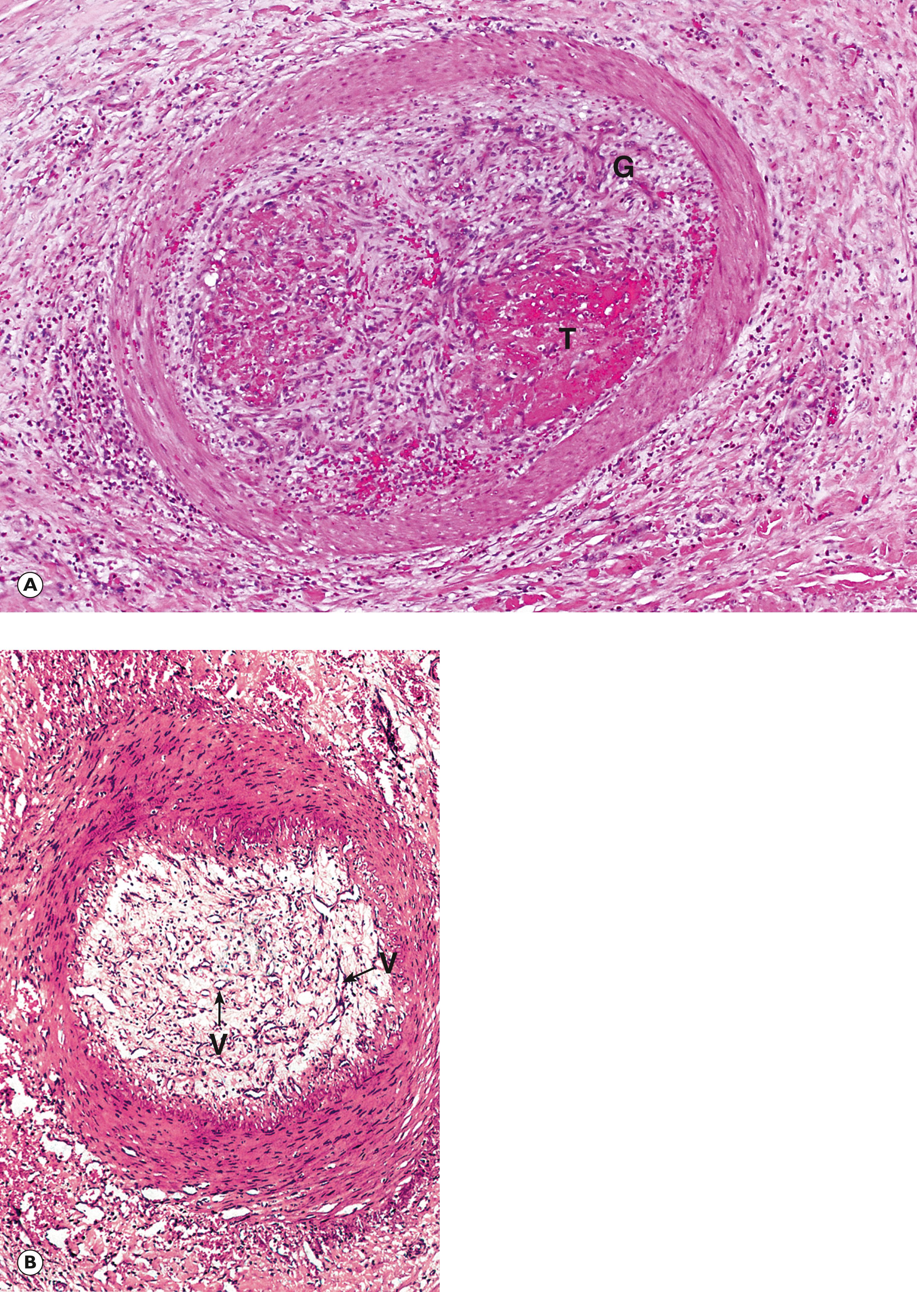 Fig. 9.7, Fate of thrombi. (A) Organisation (MP); (B) recanalisation (MP).