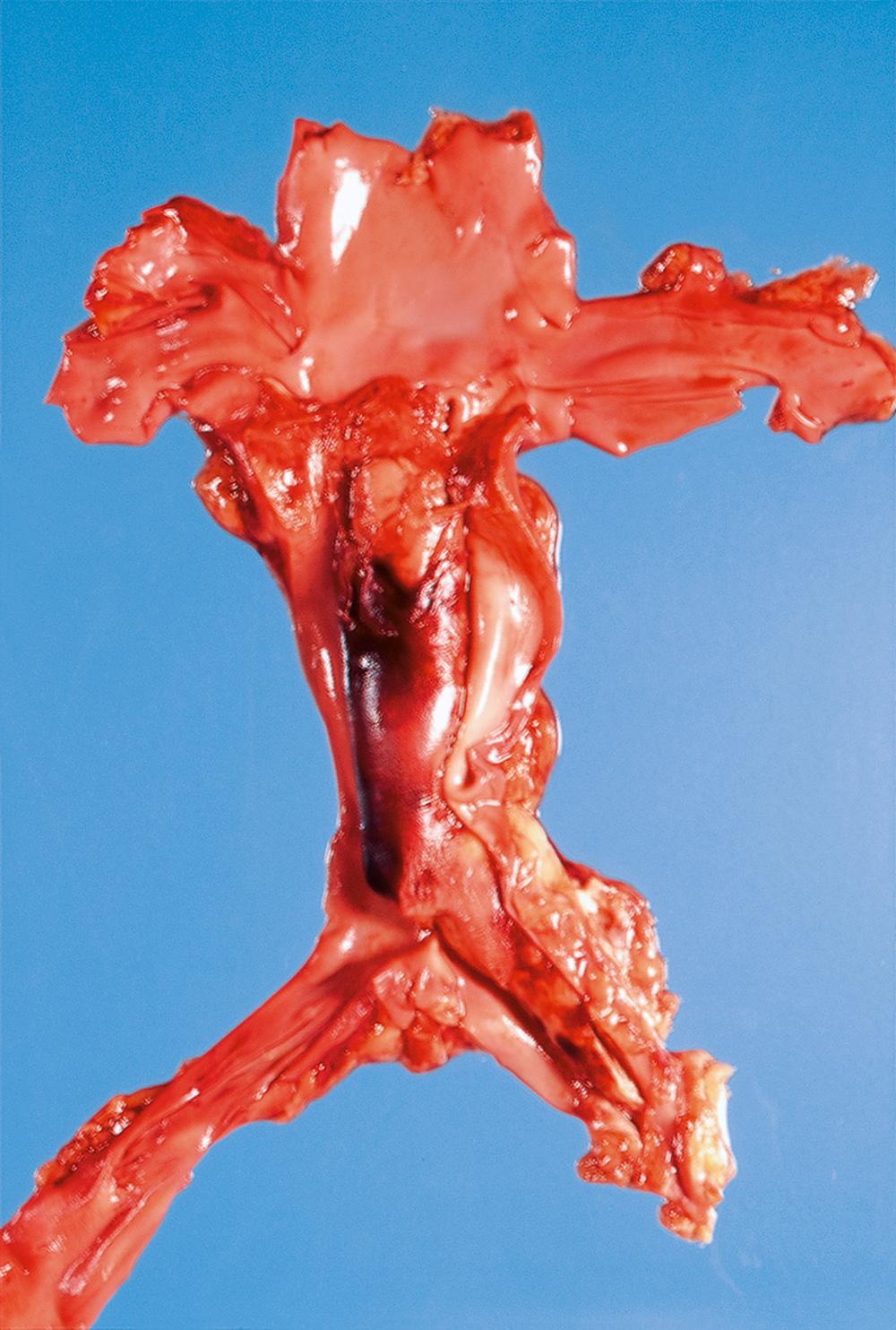 E-Fig. 9.1 G, Thrombosis of the inferior vena cava and left common iliac vein. F/70. This is a cause of oedema of the legs.