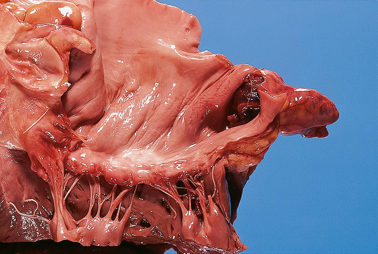 E-Fig. 9.2 G, Thrombus in the left auricular appendage. F/85. Thrombus at this site is a complication of atrial fibrillation, and may be a source of peripheral emboli.