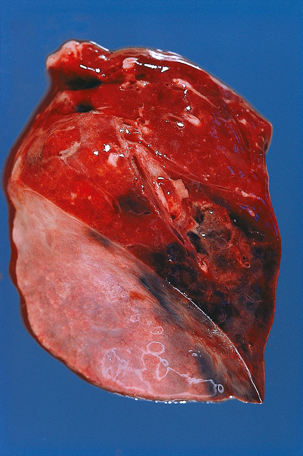 E-Fig. 9.3 G, Pulmonary embolus. Cut surface of a pulmonary infarct showing the embolus in the supplying artery at the apex of the pyramid-shaped infarct.
