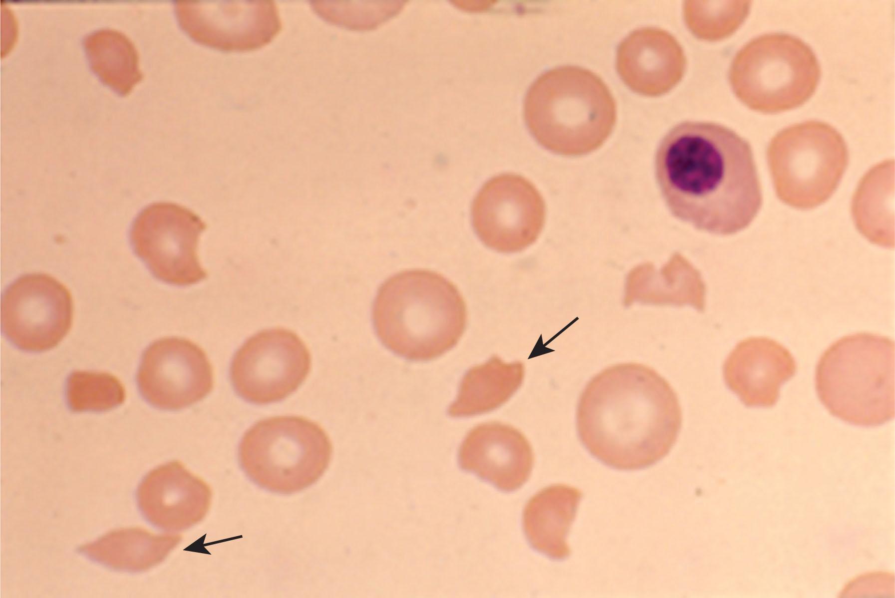 Figure 132.4, PERIPHERAL BLOOD FILM OBTAINED FROM A 28-YEAR-OLD WOMAN WHO PRESENTED WITH FEVER, EPISTAXIS, AND ALTERED MENTAL STATUS.