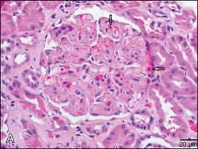 Fig. 13.1, Kidney biopsy from 49-year-old man with acute kidney injury receiving cyclosporine A, 98 days after allogeneic stem cell transplant for acute myelogenous leukemia. A. Kidney light microscopy (40X) of thrombotic microangiopathy. Open arrows : intracapillary thrombosis. Closed arrow : fragmented red blood cells (schistocytes). B. Kidney electronic microscopy of thrombotic microangiopathy. Open arrow : double contour of basement membrane.