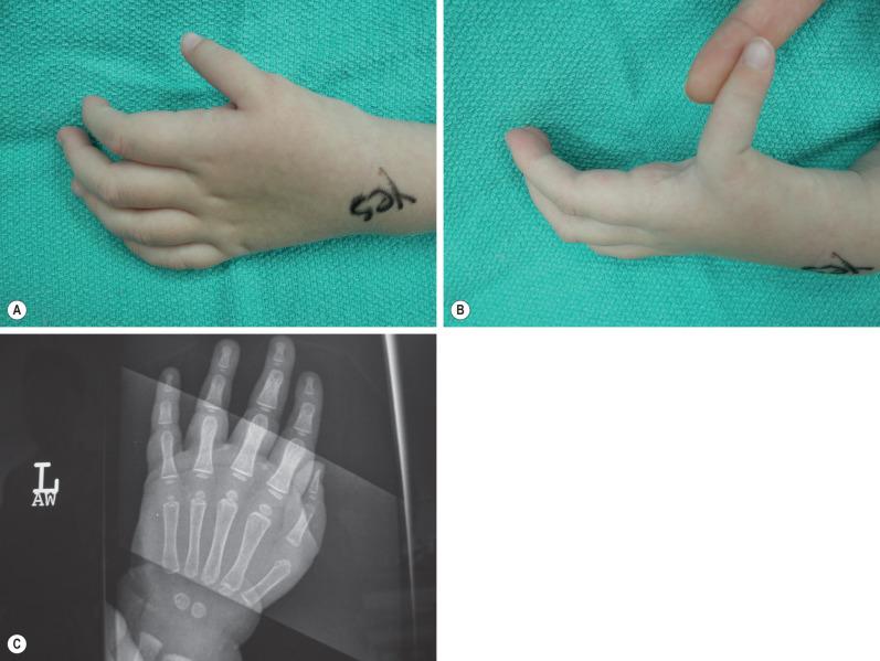 Fig. 5.3.2, Blauth 3A thumb hypoplasia. The thumb is adducted at the first web space and abducted at the metacarpophalangeal joint (A and B). The radiograph (C) demonstrates a stable carpometacarpal joint.