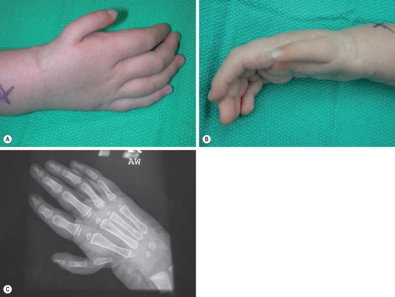 Fig. 5.3.3, (A–C) The opposite hand had a 3B hypoplastic thumb. Note the lack of a definite metacarpal base in the radiograph, characteristic of the 3B deformity.