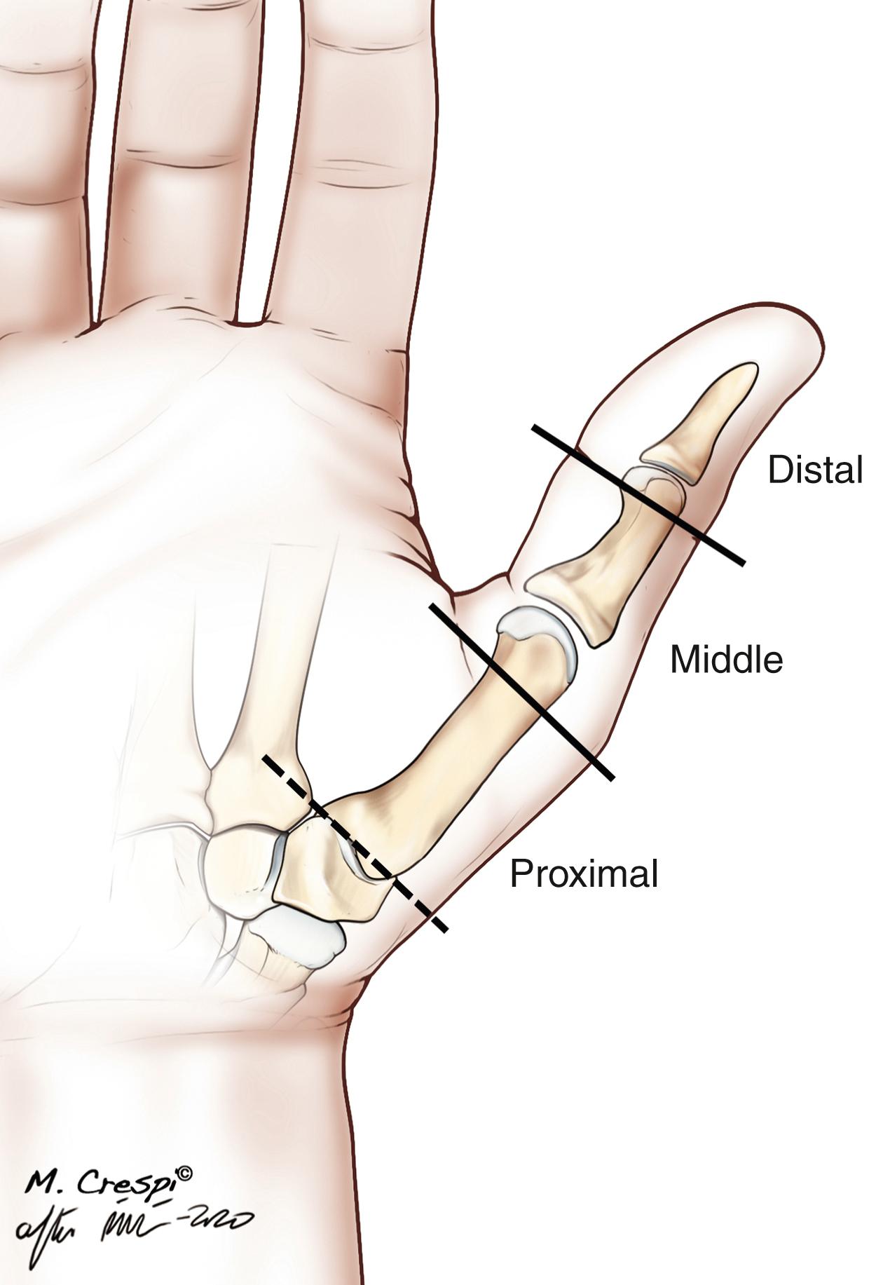 Fig. 48.1, Areas of thumb loss considered in this chapter.