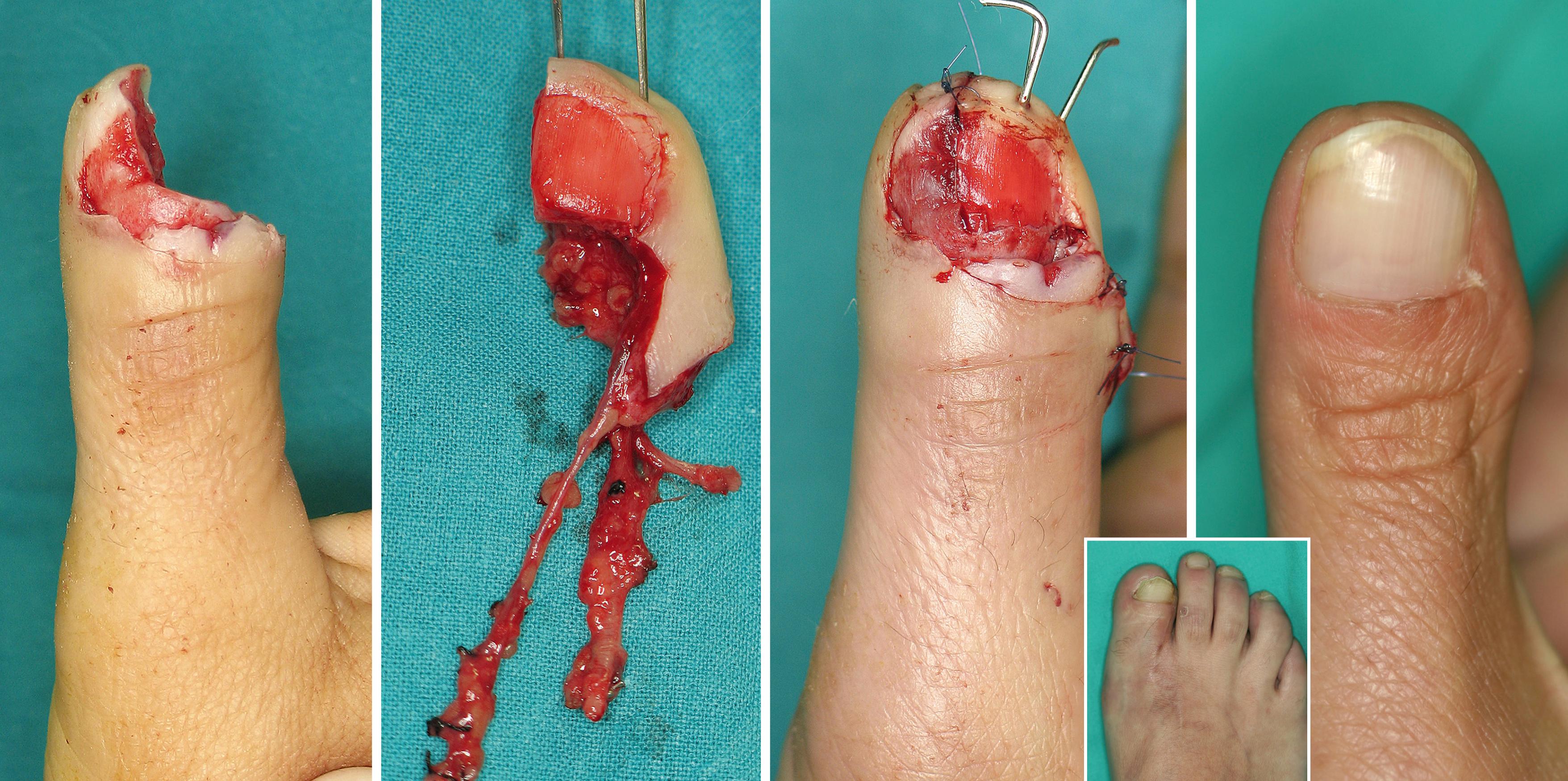 Fig. 48.11, A customized flap has solved the problem of a nonadhering nail (see text for details). In the inset, the donor site.