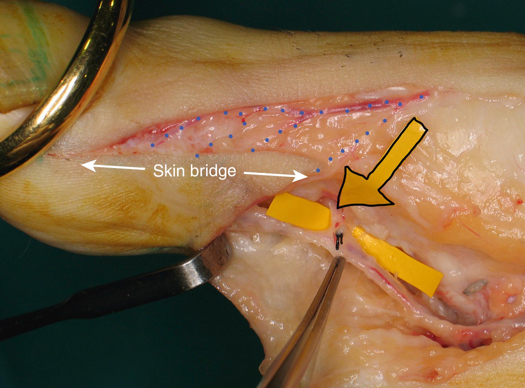 Fig. 48.12, A portion of the pulp has to include a skin bridge to preserve the tiny and fragile veins in the skin bridge that drain into the larger dorsal veins (blue dots) . The yellow arrow points to the transverse digital artery that originates at the neck of the proximal phalanx.