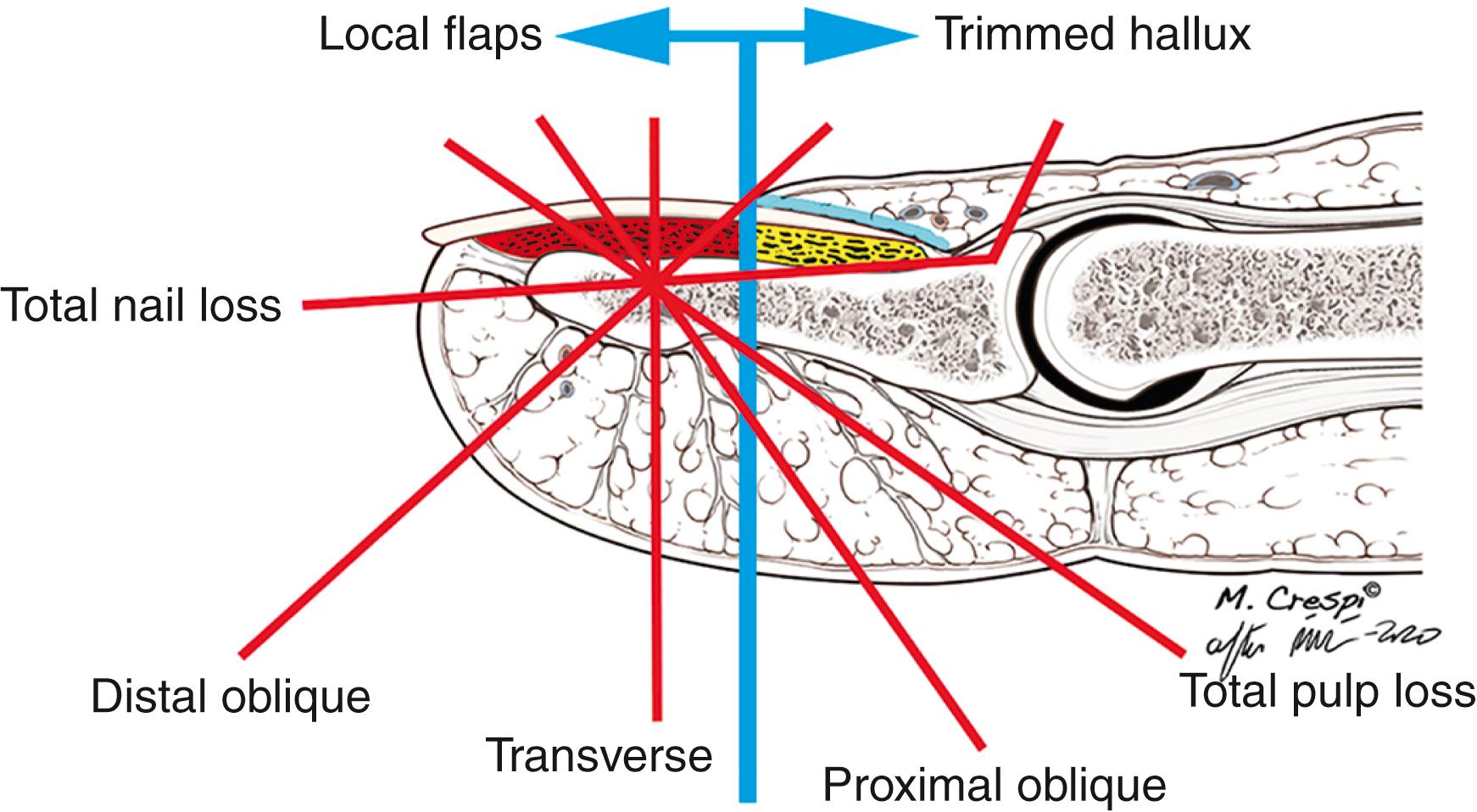 Fig. 48.13, The significance the author gives to the remaining nail at decision-making time can be inferred by the blue line: Proximal to it, the choice will be tilted toward a hallux transfer. (Sterile matrix in red; germinative matrix in yellow; eponychium in blue). See text for details.