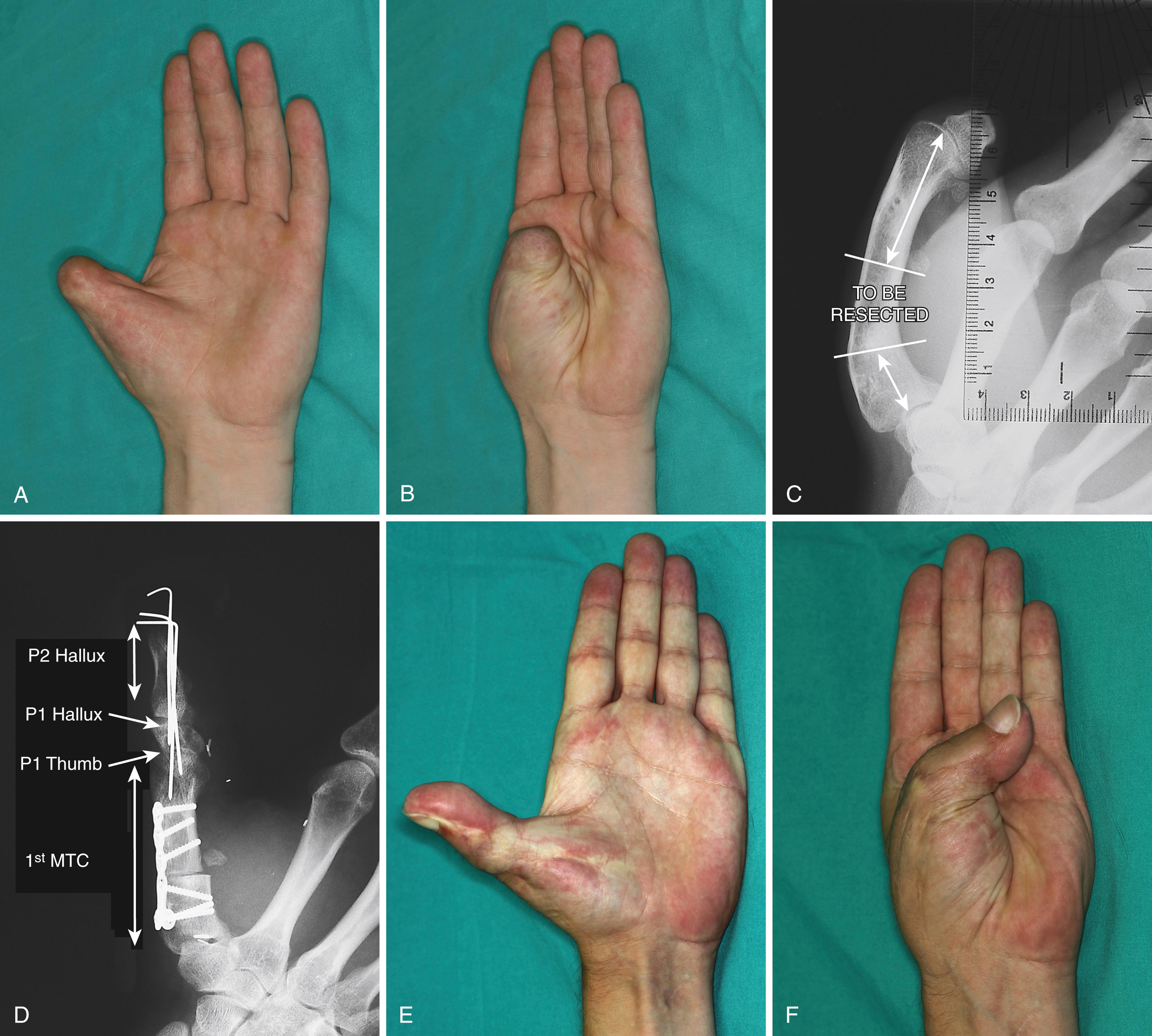 Fig. 48.23, A and B, This 35-year-old sustained at the age of 20 a traumatic thumb amputation that was managed by lengthening and a kite flap. He had been seeking a better alternative ever since. C and D, The author offered to straighten and shorten the metacarpal, and at the same time to carry out a trimmed toe hallux transfer. E and F, Result at 3 years. (Note osteoarthritic changes in the basal joint secondary to the lengthening in C and D ).