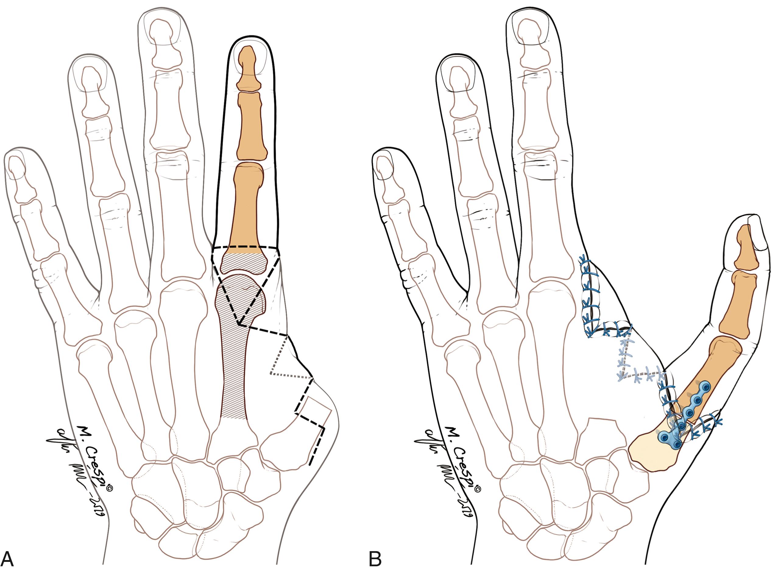 Fig. 48.19, A, A zigzag incision has been made in the web. The amount of bone to be resected is cross-hatched. B, The pollicization completed.