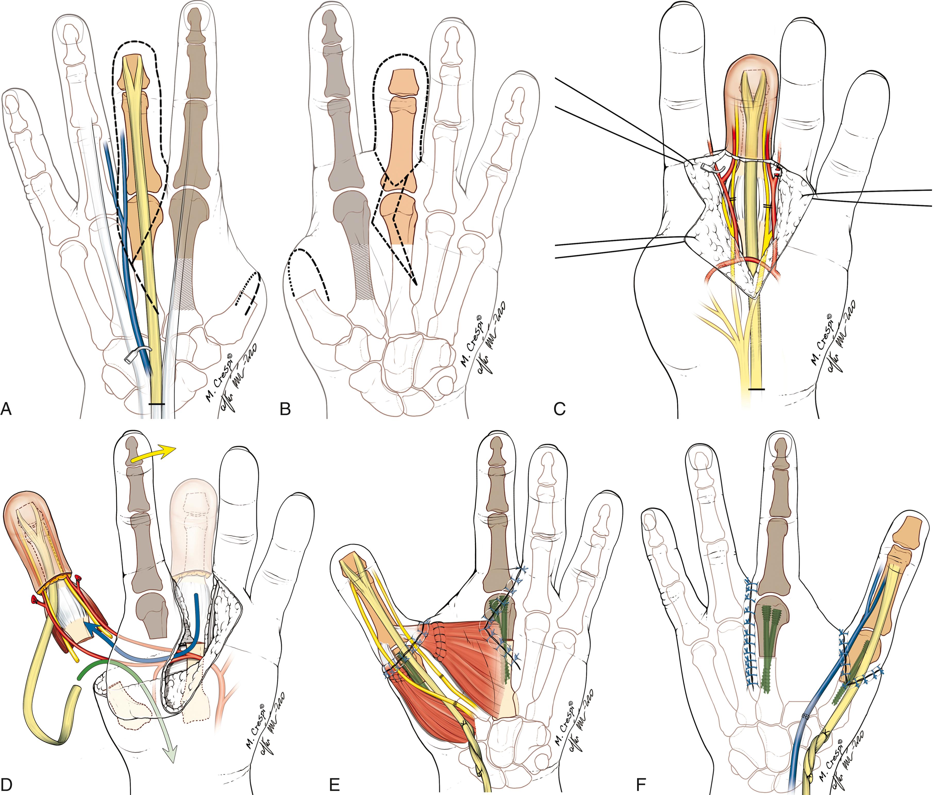 Fig. 48.20, A to F, Author’s recommended technique for pollicization of a middle finger stump. Note that the nerves of the middle finger are “reconnected” to the nerve of the thumb.