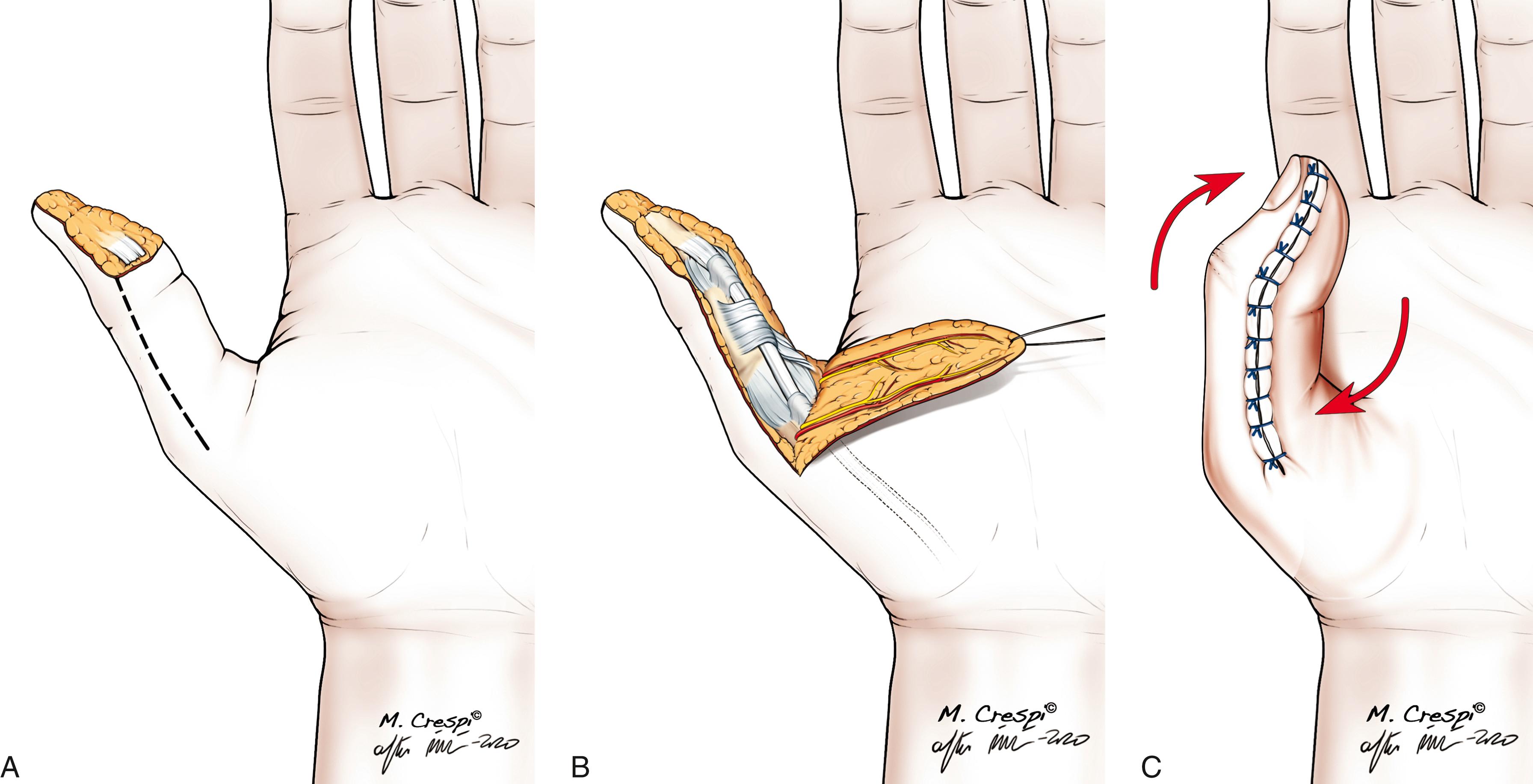 Fig. 48.3, A to C, The flap is raised through two midaxial incisions. Both neurovascular bundles are included in the flap. Some flexion contracture is permitted temporarily for closure.