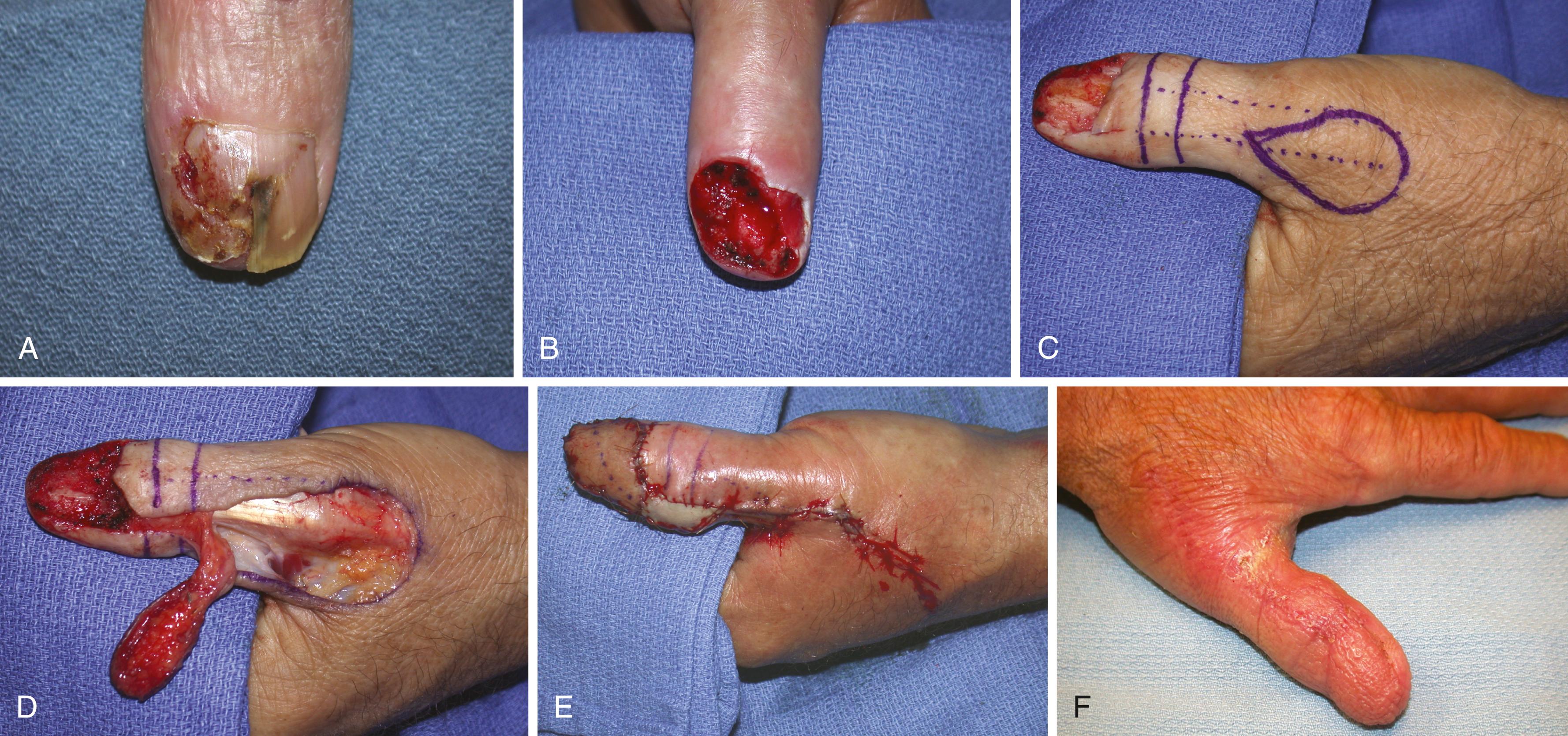 Fig. 48.6, Brunelli flap reconstruction of the dorsal thumb. A, Squamous cell carcinoma of the nail bed. B, Total excision of the nail complex and distal phalanx dorsal cortex with clear surgical margins. C, Marking of the flap and the course of the dorsoulnar artery of the thumb pedicle. D, Elevation and rotation of the flap. E, Flap inset and closure of the donor site with a rotation flap. F, Results 6 weeks after surgery.