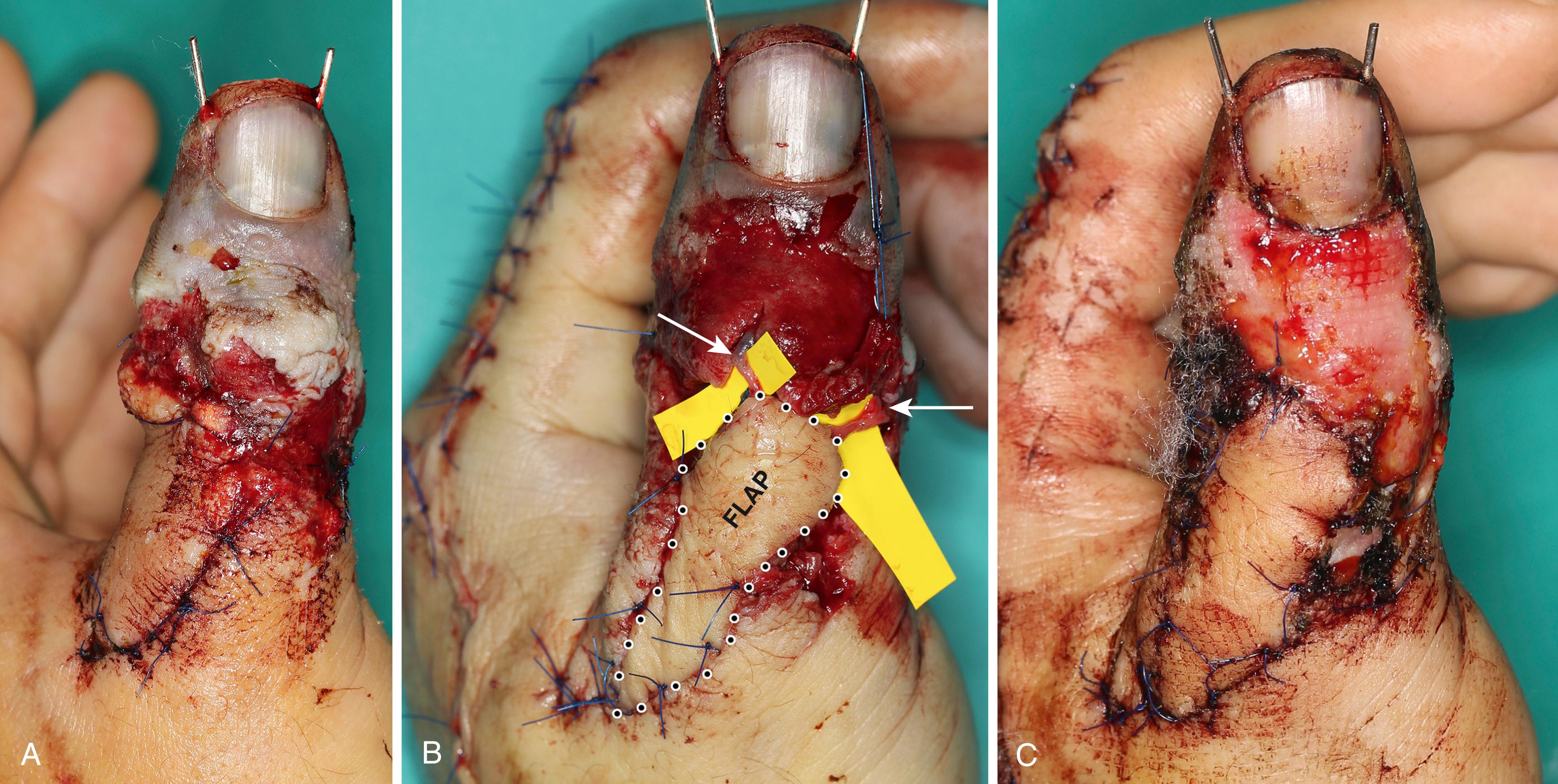 Fig. 48.8, A, This patient was referred 48 hours after replantation for impending venous failure. B, A 1.0 × 2.5 cm first dorsal metacarpal flap was elevated from the dorsum of the index, permitting primary closure of the donor site. The flap eased the circular soft tissue constriction of the thumb, and most importantly carried two veins restoring outflow of the thumb (blue arrows) . C, Complete survival at 2 weeks.