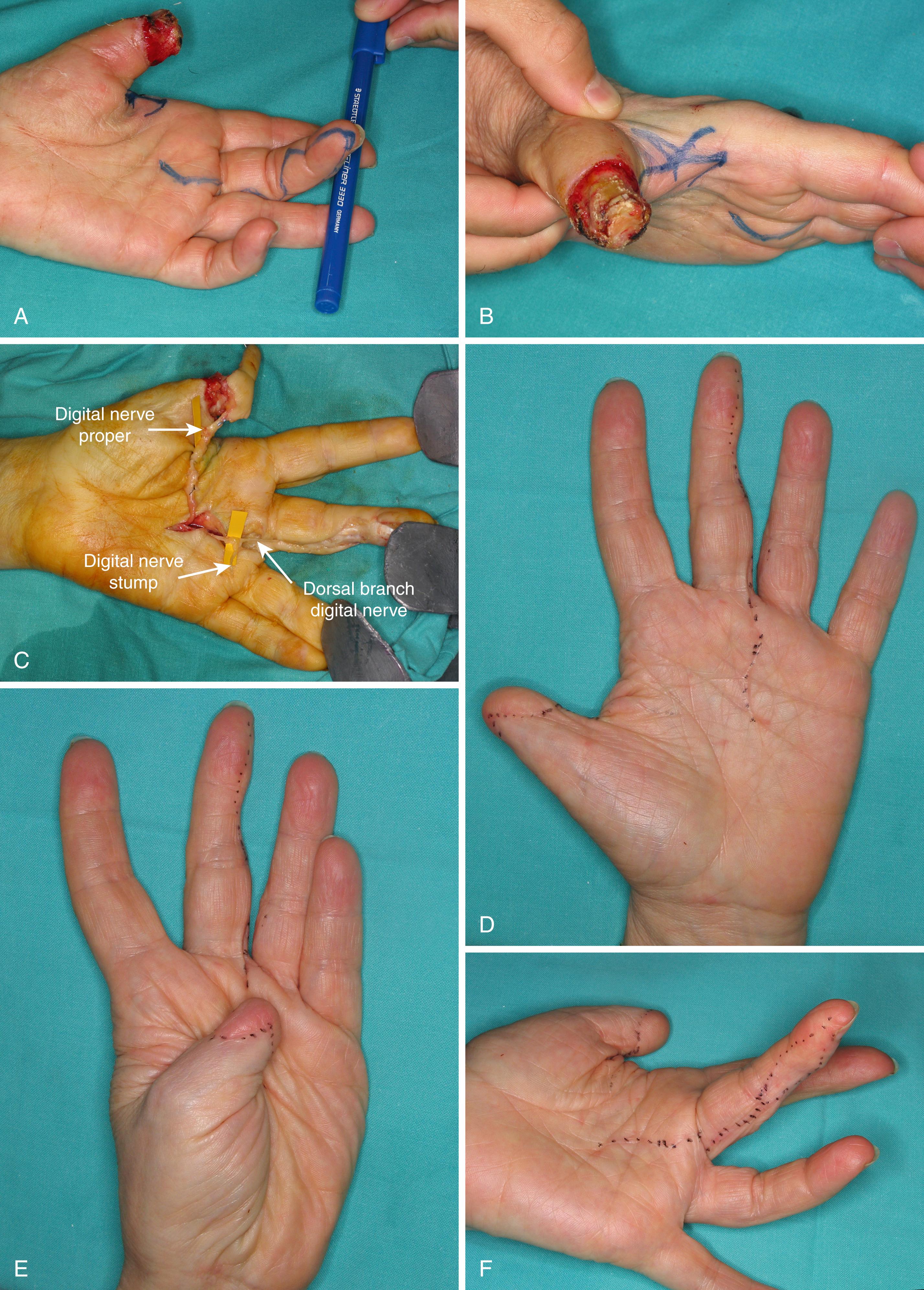 Fig. 48.10, A and B, This 68-year-old patient suffered an avulsion amputation of her thumb in a car accident 10 days prior to her visit. She rejected a toe transfer. A large Littler flap, which allowed coverage of the palmar and dorsal defect, was planned. In order to increase the effective length of the thumb, a double opposing Z-plasty was done concomitantly. C, The flap has now been elevated and prepared to be transposed under a skin tunnel (see the text for correct handling of the nerves). D and E, The function at 1 year is shown. F, The donor site was partially closed and the remaining defect covered with a full-thickness skin graft.