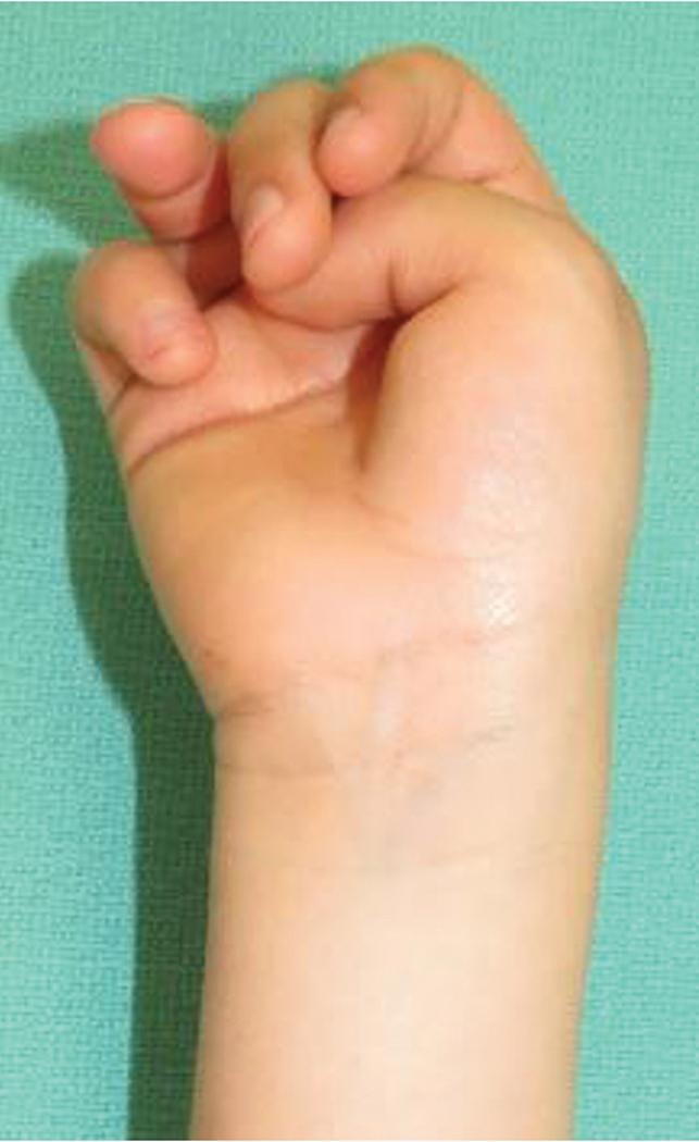 FIGURE 102.1, Thumb-in-palm deformity resulting from spastic contraction of the thenar musculature, predominantly the adductor pollicis.