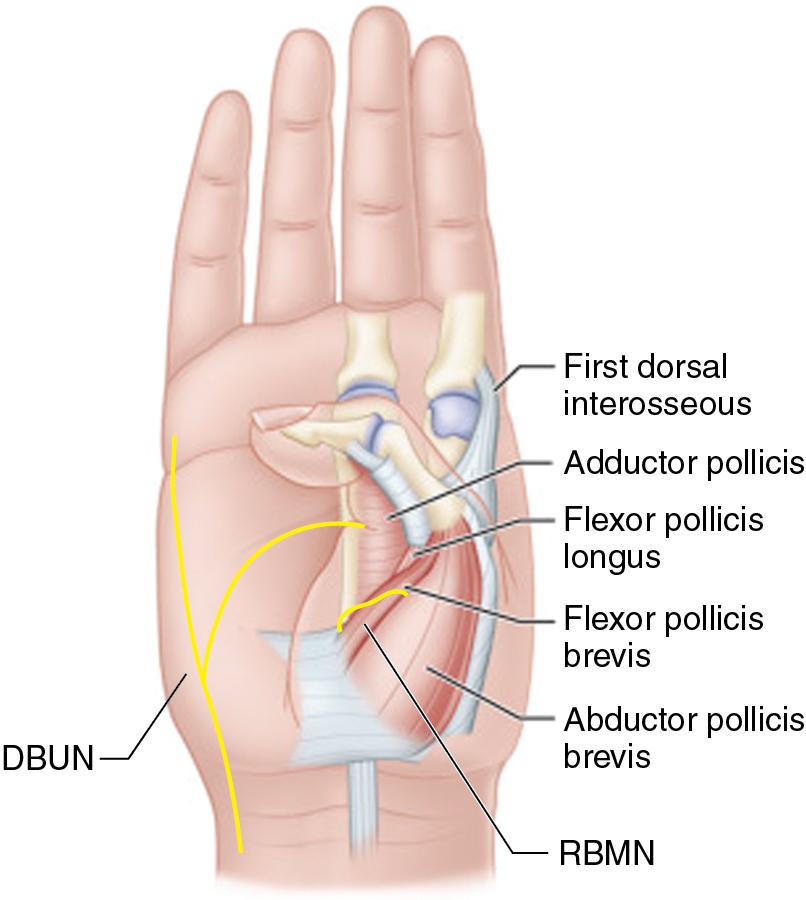 FIGURE 102.2, The contracted thenar musculature involved in thumb-in-palm deformity. When releasing the adductor pollicis muscle and the flexor pollicis brevis, the DBUN and RBMN should be protected, respectively. DBUN, Deep branch of the ulnar nerve; RBMN, recurrent branch of the median nerve.