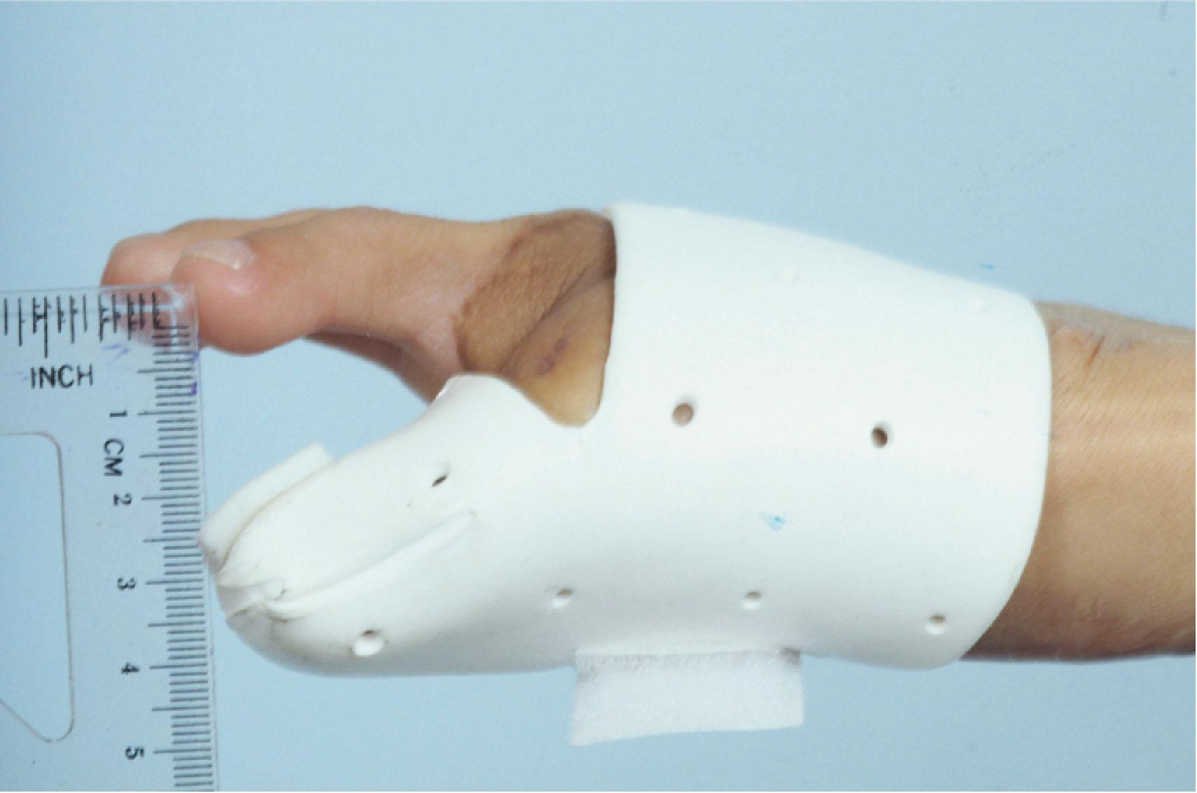 Figure 14.5, Use of a prosthetic thumb for a type IIC metacarpal hand after combined second- and third-toe transplantation for middle- and ring-finger reconstruction. This is useful for determining the exact position of the future transplanted thumb and for planning additional procedures (e.g., opponensplasties).