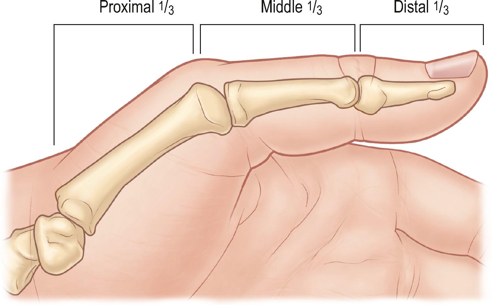 Figure 13.1, Thumb loss classification, divided into thirds. Distal third is from thumb tip to interphalangeal joint. Middle third is interphalangeal joint to metacarpal neck. Proximal third is metacarpal neck to carpometacarpal joint.