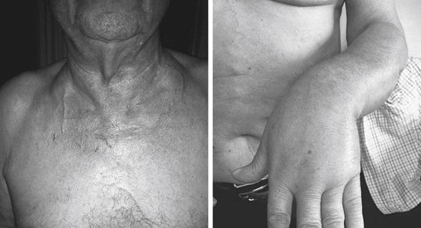 Fig. 56.1, Superior vena cava syndrome in a patient with advanced thymoma causing superior vena cava obstruction. The superficial chest venous network and the upper limb edema are evident.