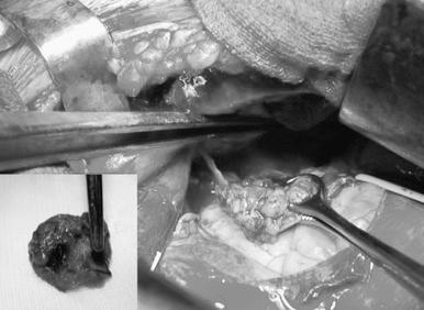 Fig. 56.2, Phrenic nerve involvement in an invasive thymic carcinoma.