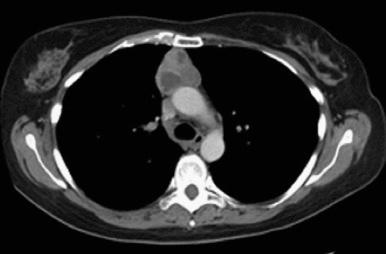 Fig. 56.3, Computed tomography of thymoma.