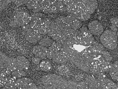 Fig. 56.4, Spindle cell type A thymoma with micronodular pattern.