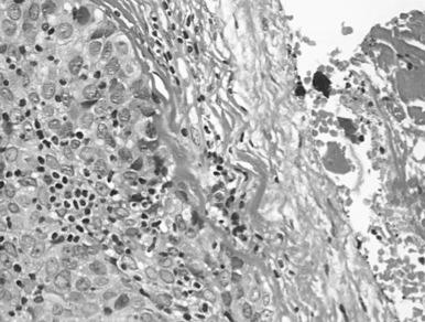 Fig. 56.5, Type B3 thymoma with atypical epithelial cells intermingled with sparse lymphocytes. Fine capsule with ink marking of the cauterized resection margin.