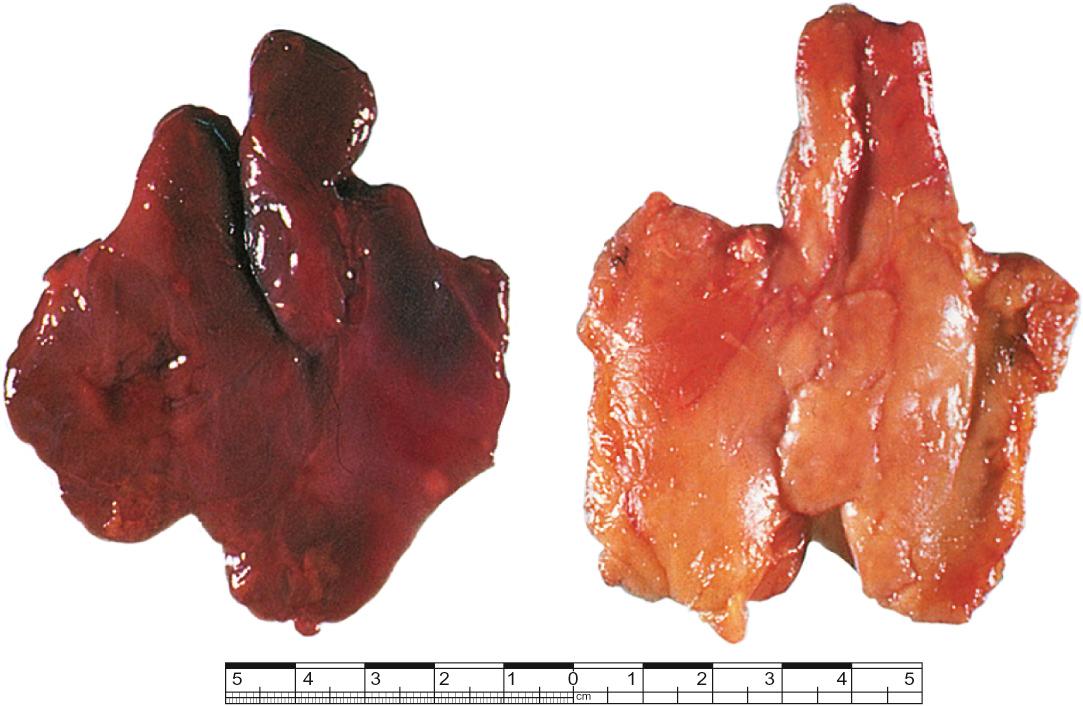 Fig. 48.2, A thymus from a 9-year-old female (left) and one from an 80-year-old male (right). Note the fibrofatty infiltration of the older thymus.