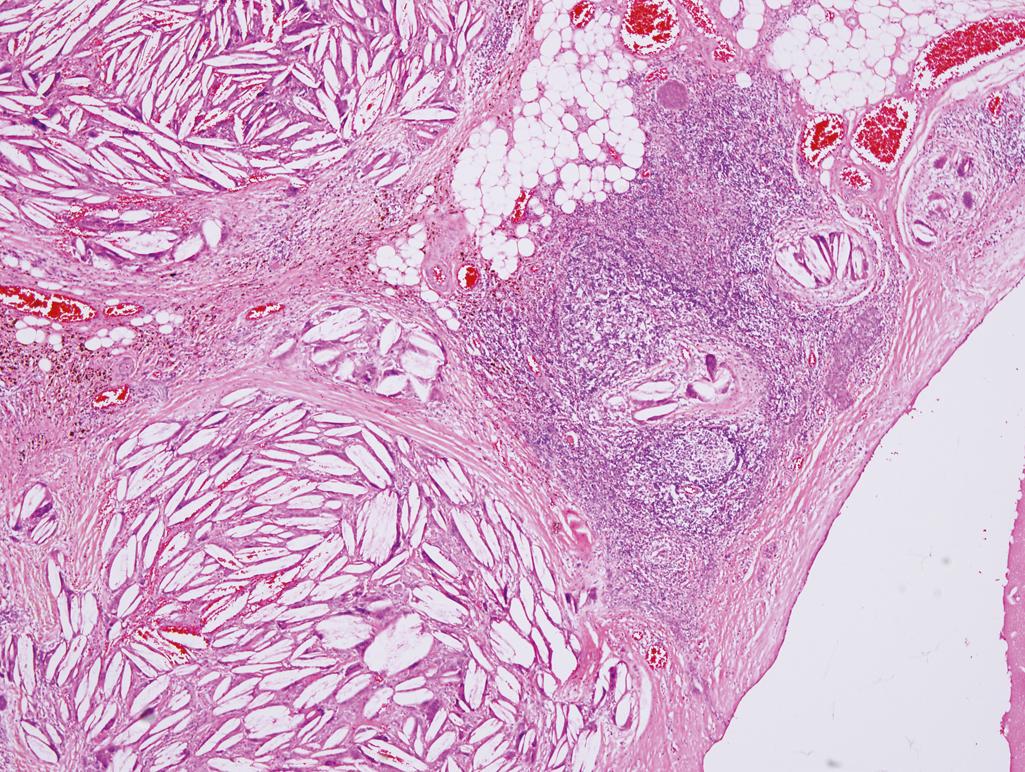 Figure 5.1, Thymic cyst.